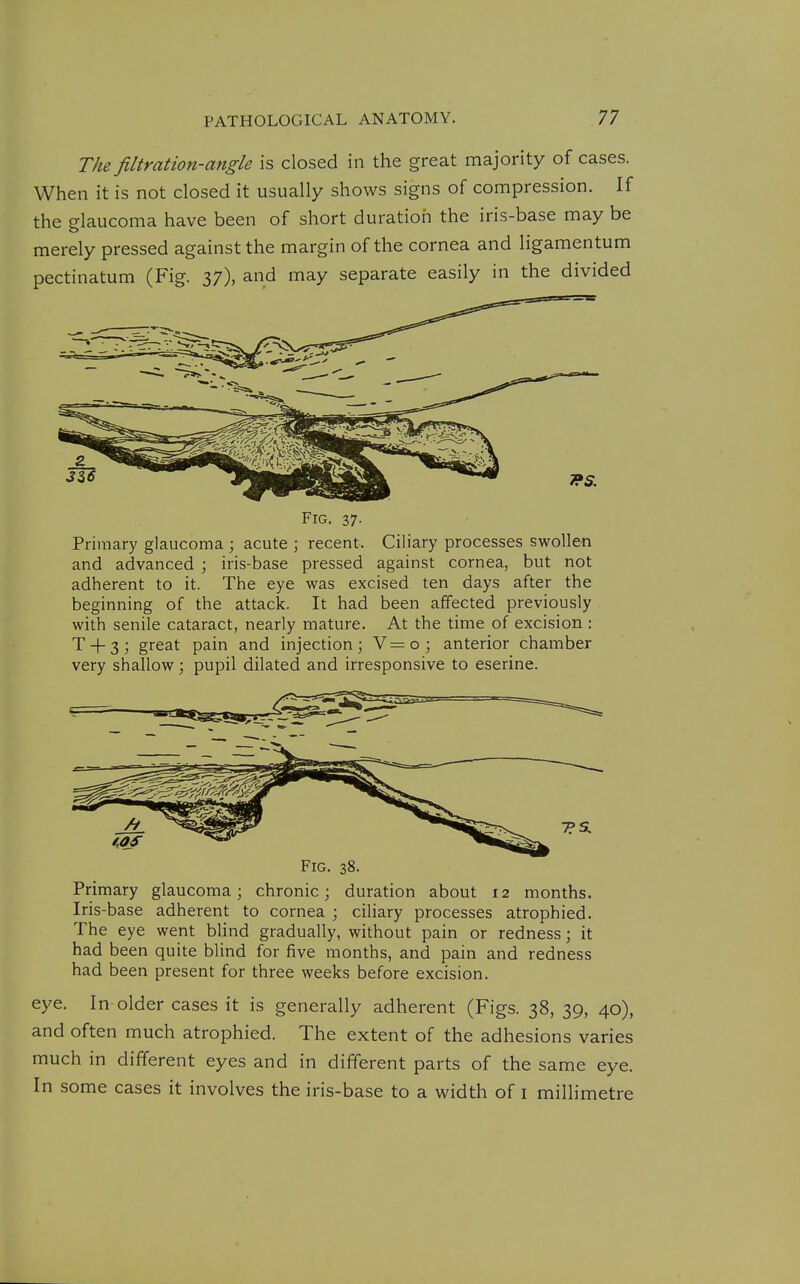 The filtration-angle is closed in the great majority of cases. When it is not closed it usually shows signs of compression. If the glaucoma have been of short duration the iris-base may be merely pressed against the margin of the cornea and ligamentum pectinatum (Fig. 37), and may separate easily in the divided Fig. 37- Primary glaucoma ; acute ; recent. Ciliary processes swollen and advanced ; iris-base pressed against cornea, but not adherent to it. The eye was excised ten days after the beginning of the attack. It had been affected previously with senile cataract, nearly mature. At the time of excision : T + 3; great pain and injection; V=o; anterior chamber very shallow; pupil dilated and irresponsive to eserine. Fig. 38. Primary glaucoma; chronic; duration about 12 months. Iris-base adherent to cornea ; ciliary processes atrophied. The eye went blind gradually, without pain or redness; it had been quite blind for five months, and pain and redness had been present for three weeks before excision. eye. In older cases it is generally adherent (Figs. 38, 39, 40), and often much atrophied. The extent of the adhesions varies much in different eyes and in different parts of the same eye. In some cases it involves the iris-base to a width of i millimetre