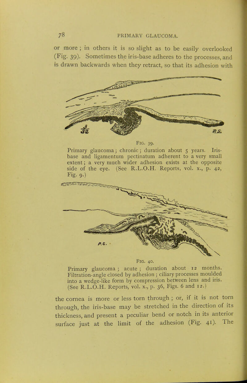 or more ; in others it is so slight as to be easily overlooked (Fig. 39)- Sometimes the iris-base adheres to the processes, and is drawn backwards when they retract, so that its adhesion with Fig. 39. Primary glaucoma; chronic; duration about 5 years. Iris- base and ligamentum pectinatum adherent to a very small extent; a very much wider adhesion exists at the opposite side of the eye. (See R.L.O.H. Reports, vol. x., p. 42, Fig. 9-) Fig, 40. Primary glaucoma ; acute ; duration about 12 months. Filtration-angle closed by adhesion ; ciliary processes moulded into a wedge-like form by compression between lens and iris. (See R.L.O.H. Reports, vol. x., p. 36, Figs. 6 and 12.) the cornea is more or less torn through ; or, if it is not torn through, the iris-base may be stretched in the direction of its thickness, and present a peculiar bend or notch in its anterior surface just at the limit of the adhesion (Fig. 41). The