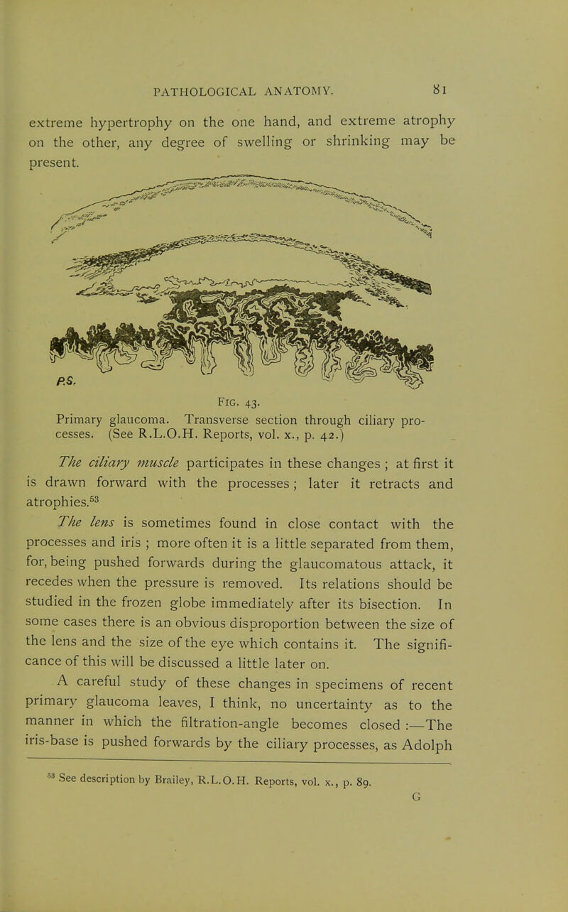 extreme hypertrophy on the one hand, and extreme atrophy on the other, any degree of swelh'ng or shrinking may be present. Fig. 43. Primary glaucoma. Transverse section through ciUary pro- cesses. (See R.L.O.H. Reports, vol. x., p. 42.) The ciliary muscle participates in these changes ; at first it is drawn forward with the processes; later it retracts and atrophies.^^ The lens is sometimes found in close contact with the processes and iris ; more often it is a little separated from them, for, being pushed forwards during the glaucomatous attack, it recedes when the pressure is removed. Its relations should be studied in the frozen globe immediately after its bisection. In some cases there is an obvious disproportion between the size of the lens and the size of the eye which contains it. The signifi- cance of this will be discussed a little later on. A careful study of these changes in specimens of recent primary glaucoma leaves, I think, no uncertainty as to the manner in which the filtration-angle becomes closed :—The iris-base is pushed forwards by the ciliary processes, as Adolph '3 See description by Brailey, R.L.O.H. Reports, vol. x., p. 89. G