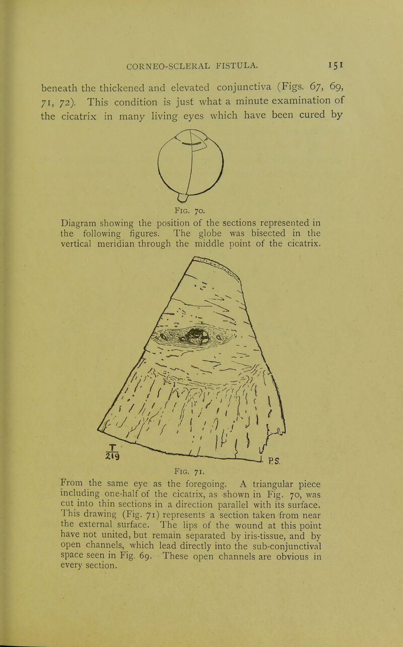 beneath the thickened and elevated conjunctiva (Figs. 67, 69, 71, 72). This condition is just what a minute examination of the cicatrix in many hving eyes which have been cured by Fig. 70. Diagram showing the position of the sections represented in the following figures. The globe was bisected in the vertical meridian through the middle point of the cicatrix. Fig. 71. From the same eye as the foregoing. A triangular piece including one-half of the cicatrix, as shown in Fig. 70, was cut into thin sections in a direction parallel with its surface. This drawing (Fig. 71) represents a section taken from near the external surface. The lips of the wound at this point have not united, but remain separated by iris-tissue, and by open channels, which lead directly into the sub-conjunctival space seen in Fig. 69. These open channels are obvious in every section.