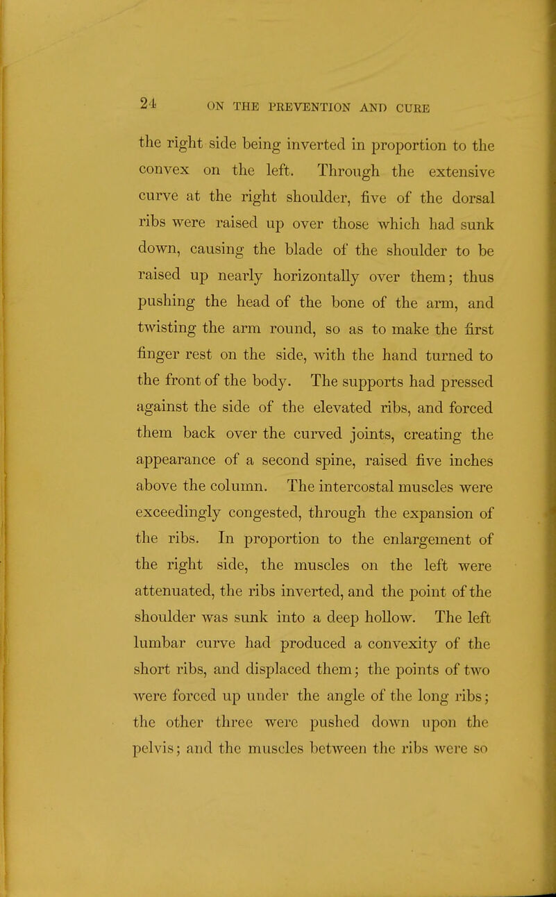 the right side being inverted in proportion to the convex on the left. Through the extensive curve at the right shoulder, five of the dorsal ribs were raised up over those which had sunk down, causing the blade of the shoulder to be raised up nearly horizontally over them; thus pushing the head of the bone of the arm, and twisting the arm round, so as to make the first finger rest on the side, with the hand turned to the front of the body. The supports had pressed against the side of the elevated ribs, and forced them back over the curved joints, creating the appearance of a second spine, raised five inches above the column. The intercostal muscles were exceedingly congested, through the expansion of the ribs. In proportion to the enlargement of the right side, the muscles on the left were attenuated, the ribs inverted, and the point of the shoulder was sunk into a deep hollow. The left lumbar curve had produced a convexity of the short ribs, and displaced them; the points of two were forced up under the angle of the long ribs; the other three were pushed down upon the pelvis; and the muscles between the ribs were so