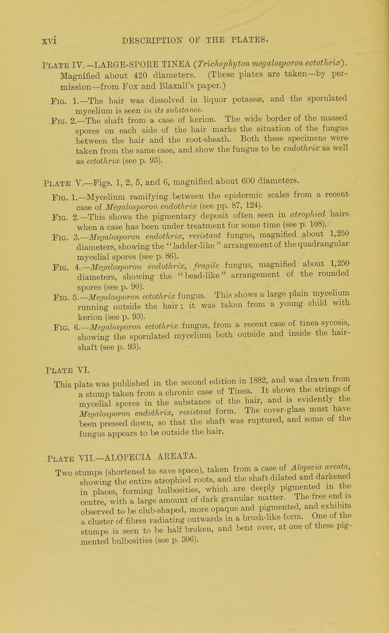 Plate IV. —LAEGE-SPOEE TINEA {Trichoxjhjtonmegalosjjoroiiectothrix'). Magnified about 420 diameters. (These plates are taken—by per- mission—from Fox and Blaxall's paper.) Fig. 1.—The hair was dissolved in liquor potassse, and the sporulated myceUum is seen in its substance. Fig. 2.—The shaft from a case of kerion. The wide border of the massed spores on each side of the hair marks the situation of the fungus between the hair and the root-sheath. Both these specimens were- taken from the same case, and show the fungus to be endothrix as well as ectothrix (see p. 93). Plate V. Figs. 1, 2, 5, and 6, magnified about 600 diameters. Fig. 1.—Mycelium ramifying between the epidermic scales from a recent case of Megalosporon endothrix (see pp. 87, 124). Fig. 2.—This shows the pigmentary deposit often seen in atrophied hairs when a case has been under treatment for some time (see p. 108). Fig. Z.—Megalosporon endothrix, resistant fungus, magnified about 1,250 diameters, showing the ladder-like arrangement of the quadrangular mycelial spores (see p. 86). Fig. a.—Megalosporon endothrix, fragile fungus, magnified about 1,250 diameters, showng the bead-like arrangement of the rounded spores (see p. 90). Fig. 5.—Megalosporon ectothrix fungus. This shows a large plam mycehum running outside the hair; it was taken from a young child mth kerion (see p. 93). Fig Megalosporon ectothrix fungus, from a recent case of tmea sycosis, showing the sporulated mycelium both outside and mside the hair- shaft (see p. 93). Plate VI. This plate was pubUshed in the second edition in 1882, and was drami from a stump taken from a chronic case of Tinea. It shows the strings of mycelial spores in the substance of the hair, and is evidently the Mecialosporon endothrix, resistant form. The cover-glass must have been pressed down, so that the shaft was ruptured, and some of the fungus appears to be outside the hair. Plate VII.—ALOPECIA AREATA. Two stumps (shortened to save space), taken from a case of Alopecia areaia^ showing the entire atrophied roots, and the shaft dilated and darkened in places, forming bulbosities, which are deeply Pigmented in the cenL, with a large amount of dark gi-anular matter. The free end s observed to be club-shaped, more opaque and pigmented, and exhibits a cluster of fibres radiating outwards in a brush-like orm. One of the- stumps is seen to be half broken, and bent over, at one of these pig- mented bulbosities (see p. 30C).