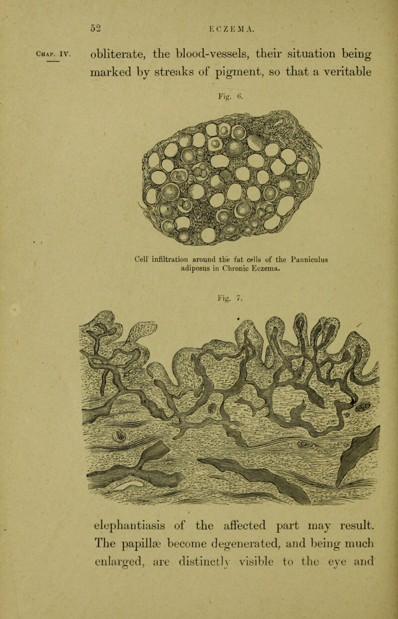 obliterate, the blood-vessels, their situation being marked by streaks of pigment, so that a veritable Fig. 6. Cell infiltration around the fat cells of the Panniculus adiposus in Chronic Eczema. Fig. 7. elephantiasis of the affected part may result. The papillae become degenerated, and being much enlarged, are distinct!} visible to the eve and