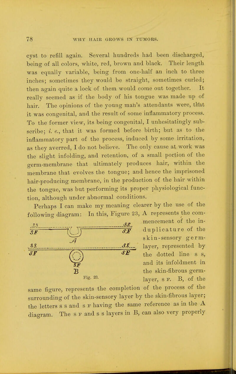 cyst to refill again. Several hundreds had been discharged, being of all colors, white, red, brown and black. Their length was equally variable, being from one-half an inch to three inches; sometimes they would be straight, sometimes curled; then again quite a lock of them would come out together. It really seemed as if the body of his tongue was made up of hair. The opinions of the young man's attendants were, that it was congenital, and the result of some inflammatory process. To the former view, its being congenital, I unhesitatingly sub- scribe; i. e., that it was formed before birth; but as to the inflammatory part of the process, induced by some irritation, as they averred, I do not believe. The only cause at work was the slight infolding, and retention, of a small portion of the o-erm-membrane that ultimately produces hair, within the membrane that evolves the tongue; and hence the imprisoned hair-producing membrane, in the production of the hair within the tongue, was but performing its proper physiological func- tion, although under abnormal conditions. Perhaps I can make my meaning clearer by the use of the following diagram: In this, Figure 23, A represents the com- mencement of the in- ■ZS _ _ *£g. -.—- __. duplicature of the Jq skin-sensory germ- vSjS .„__ *££..r layer, represented by «ST fr^\ the dotted line s s, and its infoldment in B the skin-fibrous germ- Fie- 23- layer, s f. B, of the same figure, represents the completion of the process of the surrounding of the skin-sensory layer by the skin-fibrous layer; the letters s s and s f having the same reference as in the A diagram. The s f and s s layers in B, can also very properly