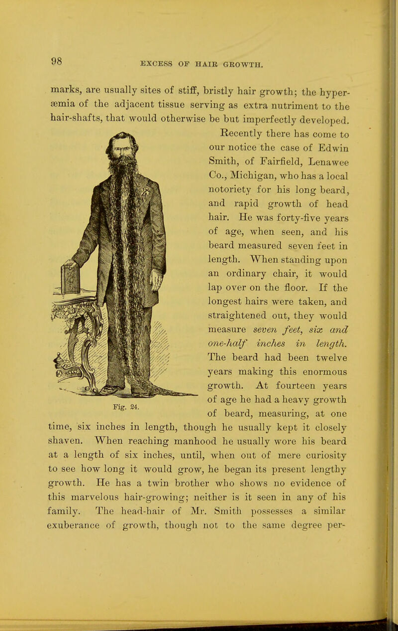 marks, are usually sites of stiff, bristly hair growth; the hyper- emia of the adjacent tissue serving as extra nutriment to the hair-shafts, that would otherwise be but imperfectly developed. Recently there has come to our notice the case of Edwin Smith, of Fairfield, Lenawee Co., Michigan, who has a local notoriety for his long beard, and rapid growth of head hair. He was forty-five years of age, when seen, and his beard measured seven feet in length. When standing upon an ordinary chair, it would lap over on the floor. If the longest hairs were taken, and straightened out, they would measure seven feet, six and one-half inches in length. The beard had been twelve years making this enormous growth. At fourteen years of age he had a heavy growth of beard, measuring, at one time, six inches in length, though he usually kept it closely shaven. When reaching manhood he usually wore his beard at a length of six inches, until, when out of mere curiosity to see how long it would grow, he began its present lengthy growth. He has a twin brother who shows no evidence of this marvelous hair-growing; neither is it seen in any of his family. The head-hair of Mr. Smith possesses a similar exuberance of growth, though not to the same degree per- Fig. 24.