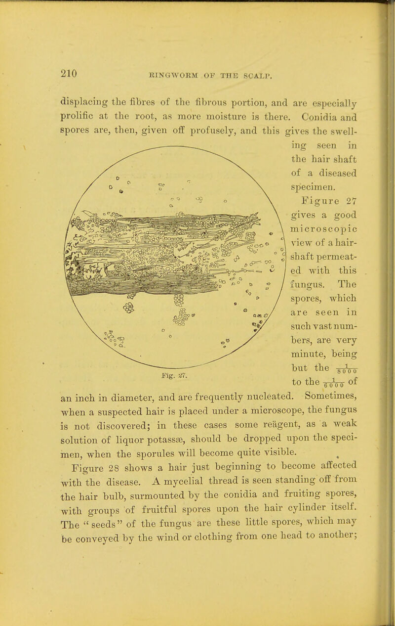 displacing the fibres of the fibrous portion, and are especially prolific at the root, as more moisture is there. Conidia and spores are, then, given off profusely, and this gives the swell- ing seen in the hair shaft of a diseased specimen. Figure 27 gives a good microscopic view of a hair- shaft permeat- ed with this fungus. The spores, which are seen in such vast num- bers, are very minute, being but the soVo- to the ^oVo of an inch in diameter, and are frequently nucleated. Sometimes, when a suspected hair is placed under a microscope, the fungus is not discovered; in these cases some reagent, as a weak solution of liquor potassse, should be dropped upon the speci- men, when the sporules will become quite visible. Figure 28 shows a hair just beginning to become affected with the disease. A mycelial thread is seen standing off from the hair bulb, surmounted by the conidia and fruiting spores, with groups of fruitful spores upon the hair cylinder itself. The seeds of the fungus are these little spores, which may be conveyed by the wind or clothing from one head to another; Fig. 27.