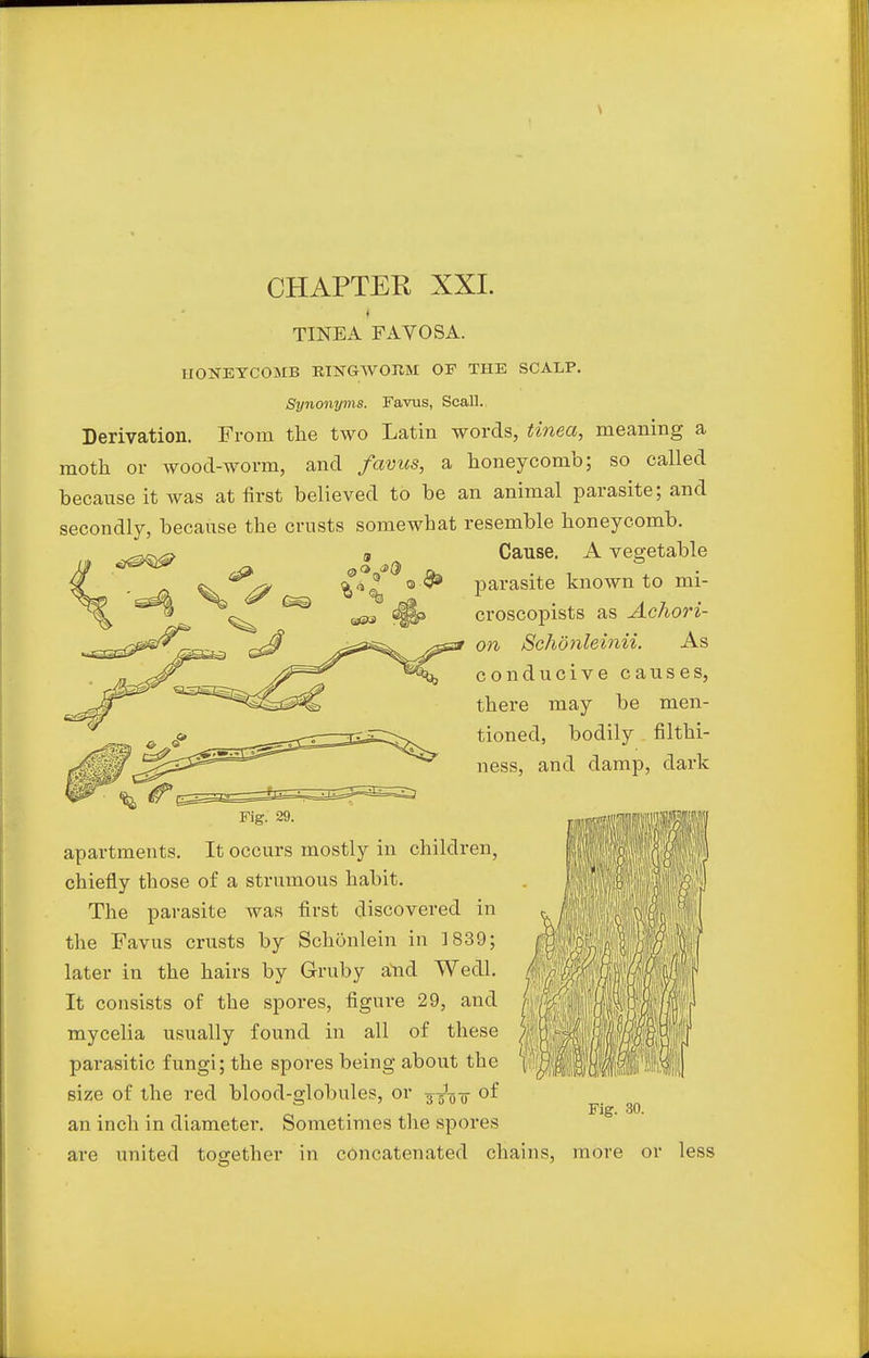 TINEA FAVOSA. HONEYCOMB RINGWOHM OF THE SCALP. Synonyms. Favus, Scall. Derivation. From the two Latin words, tinea, meaning a moth or wood-worm, and favus, a honeycomb; so called because it was at first believed to be an animal parasite; and secondly, because the crusts somewhat resemble honeycomb. Cause. A vegetable parasite known to mi- croscopists as Achori- on Schonleinii. As conducive causes, there may be men- tioned, bodily filthi- ness, and damp, dark Fig. 29. apartments. It occurs mostly in children, chiefly those of a strumous habit. The parasite was first discovered in the Favus crusts by Schonlein in 1839; later in the hairs by Gruby and Wedl. It consists of the spores, figure 29, and mycelia usually found in all of these parasitic fungi; the spores being about the size of the red blood-globules, or 3-gL-g- of an inch in diameter. Sometimes the spores are united together in concatenated chains, more or less Fig. 30.