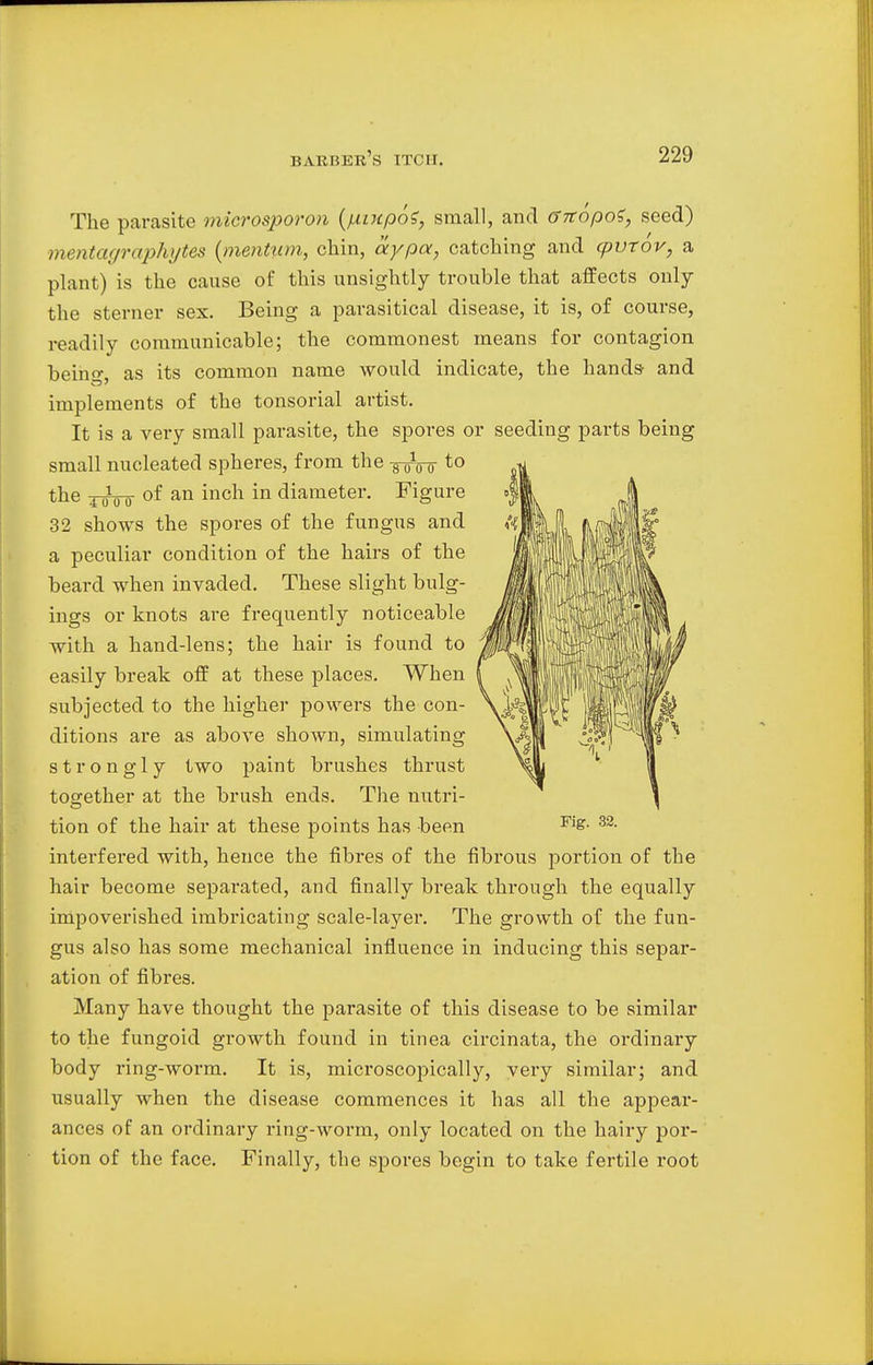 The parasite microsporon (fMupo?, small, and Gitopot, seed) mentagraphytes {mention, chin, ay pa, catching and cpvrov, a plant) is the cause of this unsightly trouble that affects only the sterner sex. Being a parasitical disease, it is, of course, readily communicable; the commonest means for contagion bein-, as its common name would indicate, the hands- and implements of the tonsorial artist. It is a very small parasite, the spores or seeding parts being small nucleated spheres, from the to the ^oo- of an inch in diameter. Figure 32 shows the spores of the fungus and a peculiar condition of the hairs of the beard when invaded. These slight bulg- ings or knots are frequently noticeable with a hand-lens; the hair is found to easily break off at these places. When subjected to the higher powers the con- ditions are as above shown, simulating strongly two paint brushes thrust together at the brush ends. The nutri- tion of the hair at these points has been Fi&- 32- interfered with, hence the fibres of the fibrous portion of the hair become separated, and finally break through the equally impoverished imbricating scale-layer. The growth of the fun- gus also has some mechanical influence in inducing this separ- ation of fibres. Many have thought the parasite of this disease to be similar to the fungoid growth found in tinea circinata, the ordinary body ring-worm. It is, microscopically, very similar; and usually when the disease commences it has all the appear- ances of an ordinary ring-worm, only located on the hairy por- tion of the face. Finally, the spores begin to take fertile root