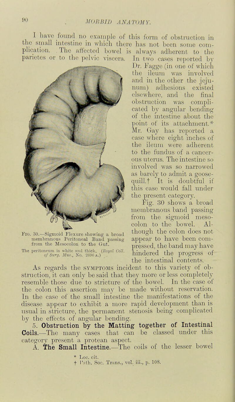 A[OllBID ANA TOM Y. I have found no cxaniple of this form of obstruction in the small intestine in which there has not been some com- plication. The aifected bowel is always adherent to the parietes or to the pelvic viscera. In two cases reported by Dr. Fagge (in one of which the ileum was involved and in the other the jeju- num) adhesions existed elsewhere, and the final obstruction was compli- cated by angular bendmg of the intestine about the point of its attachment.* Mr. Gay has reported a case where eight inches of the ileum were adherent to the fundus of a cancer- ous uterus. The intestine so involved was so narrowed as barely to admit a goose- quill, t It is doubtful if this case would fall undei the present category. Fig. 30 shows a broad membranous band passing from the sigmoid meso- colon to the bowel. Al- though the colon does not appear to have been com- pressed, the band may have hindered the progress of the intestinal contents. As regards the symptoms incident to this variety of ob- struction, it can only be said that they more or less completel}' resemble those due to stricture of the bowel. In the case of the colon this assertion may be made without reservation. In the case of the small intestine the manifestations of the disease appear to exhibit a more rapid development than is usual in stricture, the permanent stenosis being complicated by the effects of angular bending. 5. Obstruction by the Matting together of Intestinal Coils.—The many cases that can be classed under this category present a protean aspect. A. The Small Intestine.—The coils of the lesser bowel * Loc. cit. t ''''th. Soc. Trans., vol. iii., p. 108. Fig. 30.—Sigmoid Flexure showing a broad membranous Peritoneal Band passing from the Mesocolon to the Gut. The peritoneum is white niid thick. {Royal Coll. of Stcrg. Mns., No. 2(i9()A.)