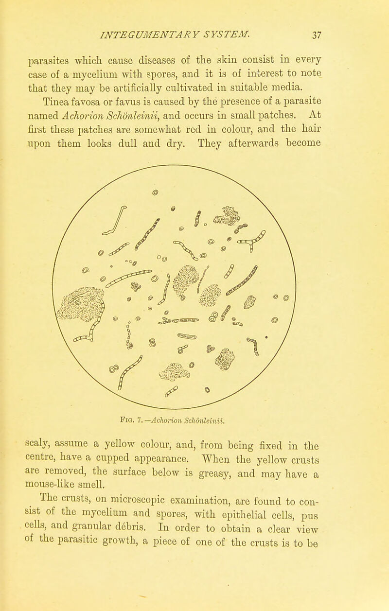 parasites which cause diseases of the skin consist in every case of a mycelium with spores, and it is of interest to note that they may be artificially cultivated in suitable media. Tinea favosa or favus is caused by the presence of a parasite named Achorion Schdnleinii, and occurs in small patches. At first these patches are somewhat red in colour, and the hair upon them looks dull and dry. They afterwards become Fio. 7. —Achorion Schdnleinii. scaly, assume a yellow colour, and, from being fixed in the centre, have a cupped appearance. When the yellow crusts are removed, the surface below is greasy, and may have a mouse-like smell. The crusts, on microscopic examination, are found to con- sist of the mycelium and spores, with epithelial cells, pus cells, and granular debris. In order to obtain a clear view of the parasitic growth, a piece of one of the crusts is to be