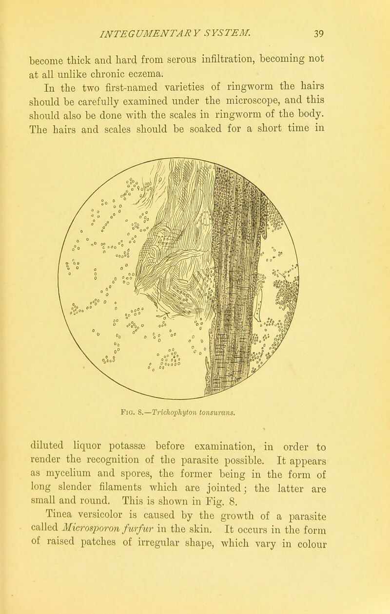 become tMck and hard from serous infiltration, becoming not at all unlike chronic eczema. In the two first-named varieties of ringworm the hairs should be carefully examined under the microscope, and this should also be done with the scales in ringworm of the body. The hairs and scales should be soaked for a short time in Fio. S.—Tnc]iox)liyton tonsurans. diluted liquor potasste before examination, in order to render the recognition of the parasite possible. It appears as mycelium and spores, the former being in the form of long slender filaments which are jointed; the latter are small and round. This is shown in Fig. 8. Tinea versicolor is caused by the growth of a parasite called Microsporon furfur in the skin. It occurs in the form of raised patches of irregular shape, which vary in colour
