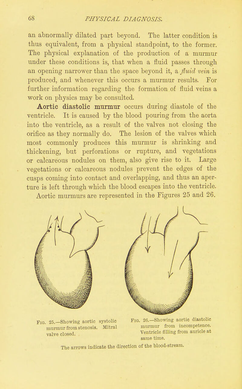 an abnormally dilated part beyond. Tlie latter condition is thus equivalent, from a physical standpoint, to the former. The physical explanation of the production of a murmur under these conditions is, that when a fluid passes through an opening narrower than the space beyond it, a fluid vein is produced, and whenever this occurs a murmur results. For further information regarding the formation of fluid veins a work on physics may be consulted. Aortic diastolic murmur occurs during diastole of the ventricle. It is caused by the blood pouring from the aorta into the ventricle, as a result of the valves not closing the orifice as they normally do. The lesion of the valves which most commonly produces this murmur is shrinking and thickening, but perforations or rupture, and vegetations or calcareous nodules on them, also give rise to it. Large vegetations or calcareous nodules prevent the edges of the cusps coming into contact and overlapping, and thus an aper- ture is left through which the blood escapes into the ventricle. Aortic murmurs are represented in the Figures 25 and 26. Fio 25 -Showing aortic systolic Fio. 26.-Sliowing aortic diastolic murmur from stenosis. Mitral murmur from incompetence, valve closed. Ventricle nUing from auncle at same time.