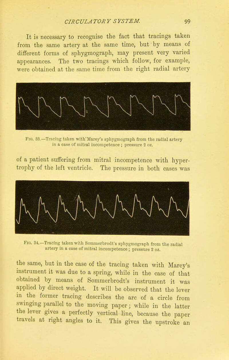 It is necessary to recognise the fact that tracings taken from the same artery at the same time, but by means of different forms of sphygmograph, may present very varied appearances. The two tracings which follow, for example, were obtained at the same time from the right radial artery Fio. 33.—Tracing taken with'Marey's sphygmograph from the radial artery in a case of mitral incompetence ; pressure 2 oz. of a patient suffering from mitral incompetence with hyper- trophy of the left ventricle. The pressure in both cases was Pio. 34.—Tracing taken with Sommerbrodt's sphygmograph from the radial artery in a case of mitral incompetence; pressure 2 oz. the same, but in the case of the tracing taken with Marey's instrument it was due to a spring, while in the case of that obtained by means of Sommerbrodt's instrument it was applied by direct weight. It will be observed that the lever in the former tracing describes the arc of a circle from swinging parallel to the moving paper; while in the latter the lever gives a perfectly vertical line, because the paper travels at right angles to it. This gives the upstroke an