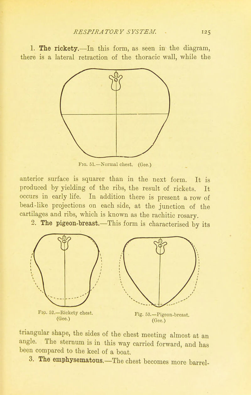 1. The rickety.—In this form, as seen in the diagram, there is a lateral retraction of the thoracic wall, while the Fig. 51.—Normal chest. (Gee.) anterior surface is squarer than in the next form. It is produced by yielding of the ribs, the result of rickets. It occurs in early life. In addition there is present a row of bead-like projections on each side, at the junction of the cartilages and ribs, which is known as the rachitic rosary. 2. The pigeon-breast.—This form is characterised by its Fio. 62.-Ric;kety chest. Kg. 63.-Pigeon-breast. (Gee.) triangular shape, the sides of the chest meeting almost at an angle. The sternum is in this way carried forward, and has been compared to the keel of a boat. 3. The emphysematous.—The chest becomes more barrel-