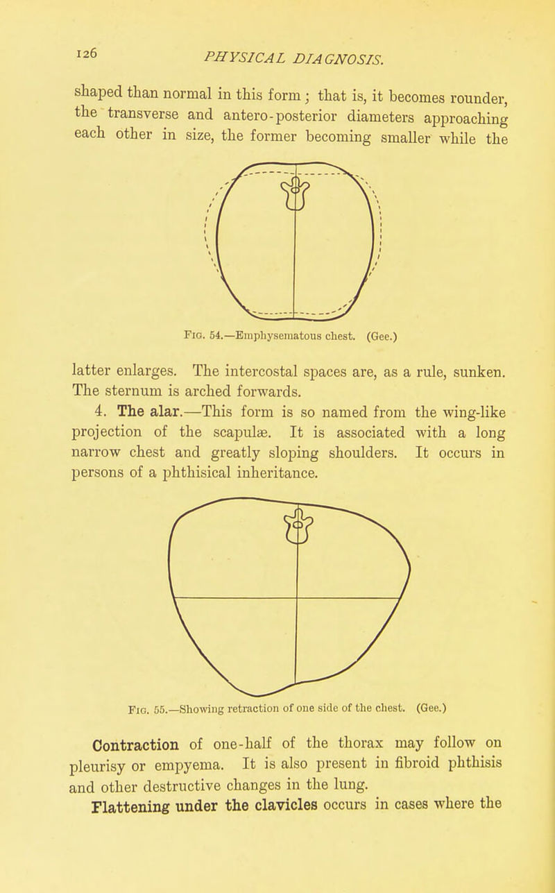 shaped than normal in this form; that is, it becomes rounder, the transverse and antero-posterior diameters approaching each other in size, the former becoming smaller while the Fig. 54.—Einpliyseinatous chest. (Gee.) latter enlarges. The intercostal spaces are, as a rule, sunken. The sternum is arched forwards. 4. The alar.—This form is so named from the wing-like projection of the scapulae. It is associated with a long narrow chest and greatly sloping shoulders. It occurs in persons of a phthisical inheritance. Fio. 55.—Showiig retraction of one side of the chest. (Gee.) Contraction of one-half of the thorax may follow on pleurisy or empyema. It is also present in fibroid phthisis and other destructive changes in the lung. Flattening under the clavicles occurs in cases where the