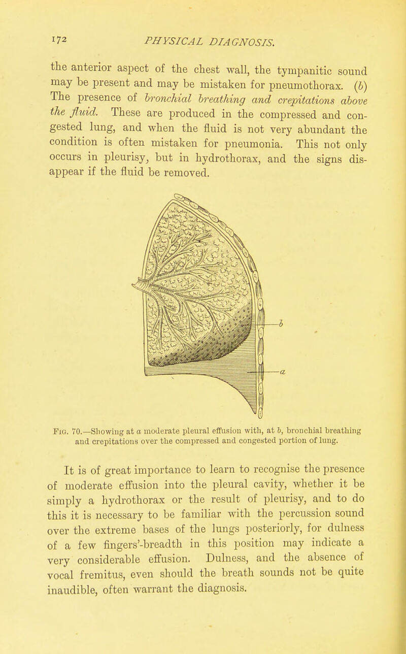 the anterior aspect of the chest wall, the tympanitic sound may be present and may be mistaken for pneumothorax. (6) The presence of bronchial hreathing and crepitations above the fluid. These are produced in the compressed and con- gested lung, and when the fluid is not very abundant the condition is often mistaken for pneumonia. This not only occurs in pleurisy, but in hydrothorax, and the signs dis- appear if the fluid be removed. Fio. 70.—Sliowiug at o moderate pleural effusion with, at 6, bronchial breathing and crepitations over the compressed and congested portion of lung. It is of great importance to learn to recognise the presence of moderate effusion into the pleural cavity, whether it be simply a hydrothorax or the result of pleurisy, and to do this it is necessary to be familiar with the percussion sound over the extreme bases of the lungs posteriorly, for duluess of a few fingers'-breadth in this position may indicate a very considerable efiusion. Duluess, and the absence of vocal fremitus, even should the breath sounds not be quite inaudible, often warrant the diagnosis.