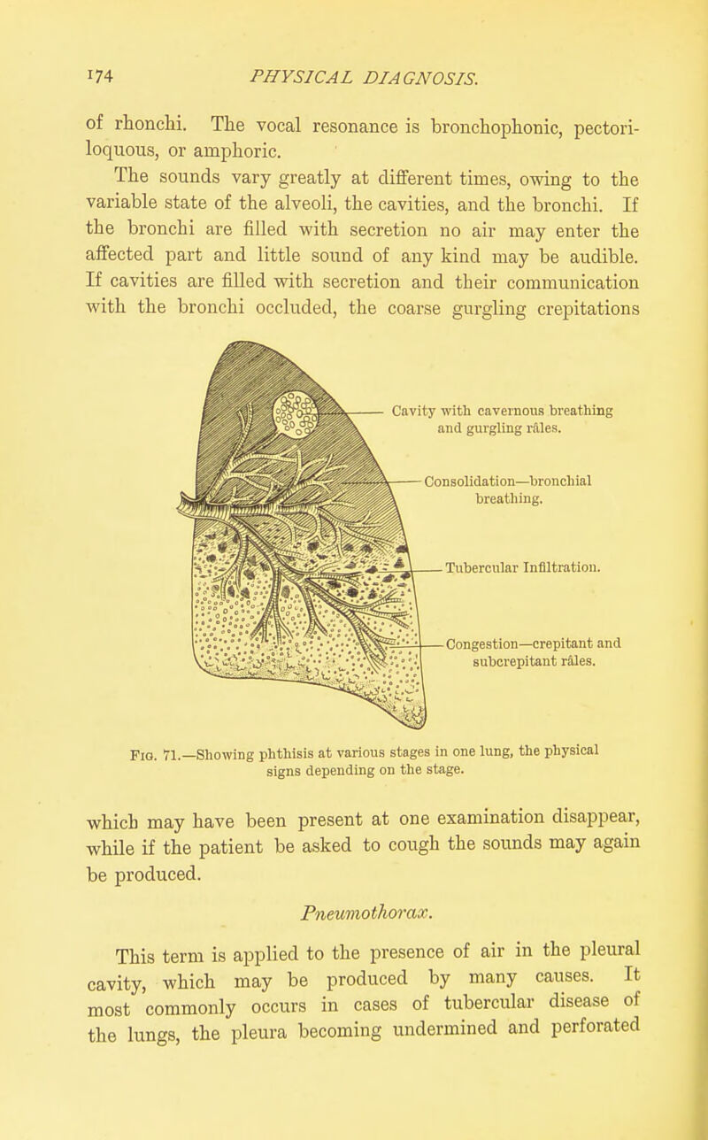 of rhonchi. The vocal resonance is broncliophonic, pectori- loquous, or amphoric. The sounds vary greatly at different times, owing to the variable state of the alveoli, the cavities, and the bronchi. If the bronchi are filled with secretion no air may enter the affected part and little sonnd of any kind may be audible. If cavities are fiUed with secretion and their communication with the bronchi occluded, the coarse gurgling crepitations which may have been present at one examination disappear, while if the patient be asked to cough the sounds may again be produced. Pneumothorax. This term is applied to the presence of air in the pleural cavity, which may be produced by many causes. It most commonly occurs in cases of tubercular disease of the lungs, the pleura becoming undermined and perforated