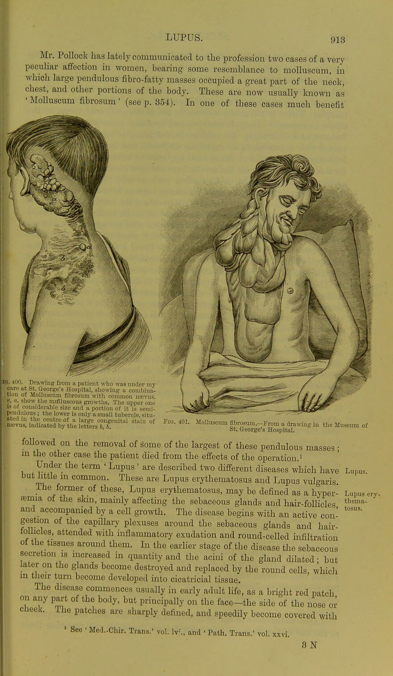 LUPUS. Mr. Pollock lias lately communicated to the profession two cases of a very peculiar affection in women, bearing some resemblance to molluscum, in which large pendulous fibro-fatty masses occupied a great part of the neck, chest, and other portions of the body. These are now usually known as ' Molluscum fibrosum' (see p. 854). In one of these cases much benefit 10. 400. Drawing from a patient who was under my care at St. George's Hospital, showing a combina- tion of Molluscum fibrosum with common uajvus «, fi, show tlie mulluscous growths. The upper one IS of considerable size and a portion of it is serai- pendulous ; the lower is only a small tubercle, situ- ated m the centre of a large congenital stain of nievna, indicated by the letters 6, b. Fig. 401. Molluscum fibrosum.—From a drawing in the Museum of St. George's Hospital. Lupus ery. tliema- tosus. followed on the removal of some of the largest of these pendulous masses • m the other case the patient died from the effects of the operation. • Under the term ' Lupus ' are described two different diseases which have Lupus but little m common. These are Lupus erythematosus and Lupus vulgaris. The former of these, Lupus erythematosus, may be defined as a hyper- femia of the skm, mainly affecting the sebaceous glands and hair-folhcles and accompanied by a cell growth. The disease begins with an active con- gestion of the capillary plexuses around the sebaceous glands and hair- tollicles, attended with inflammatory exudation and round-celled infiltration ot the tissues around them. Li the earlier stage of the disease the sebaceous secretion IS increased in quantity and the acini of the gland dilated; but later on the glands become destroyed and replaced by the round cells, which in tlieir turn become developed into cicatricial tissue. The disease commences usually in early adult life, as a bright red patch on any part of the body, but principally on the face-the side of the nose or ciieek. ihe patches are sharply defined, and speedily become covered with See ' MecL-Chir. Trans.' vol lv=., and ' Path. Trans.' vol. xxvi. 8 N