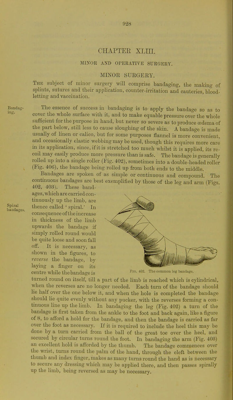 CHAPTER XLin. Bandag- injr. Spiral baadaces. MINOR AND OPERATIVE SURGERY. MINOR SURGERY. The subject of minor surgery will comprise bandaging, the making of splints, sutures and their application, counter-irritation and cauteries, blood- letting and vaccination. The essence of success in bandaging is to apply the bandage so as to cover the whole surface with it, and to make equable pressure over the whole sufficient for the purpose in hand, but never so severe as to produce oedema of the part below, still less to cause sloughing of the skin. A bandage is made usually of linen or calico, but for some purposes flannel is more convenient, and occasionally elastic webbing may be used, though this requires more care in its apphcation, since, if it is stretched too much whilst it is apphed, its re- coil may easily produce more pressure than is safe. The bandage is generally rolled up into a single roller (Fig. 402), sometimes into a double-headed roller (Fig. 406), the bandage being rolled up from both ends to the middle. Bandages are spoken of as simple or continuous and compound. The continuous bandages are best exemplified by those of the le-^ and arm (Figs 402, 403). These band- ages, which are carried con- tinuously up the limb, are thence called ' spiral.' In consequence of the increase in thickness of the limb upwards the bandage if simply rolled round would be quite loose and soon fall off. It is necessary, as shown in the figures, to reverse the bandage, by laying a finger on its centre while the bandage is turned round on itself, till a part of the limb is reached which is cylindrical, when the reverses are no longer needed. Each turn of the bandage should lie half over the one below it, and when the hole is completed the bandage should He quite evenly without any pucker, with the reverses forming a con- tinuous hne up the limb. In bandaging the leg (Fig. 402) a turn of the bandage is first taken fi'om the ankle to the foot and back again, like a figure of 8, to afford a hold for the bandage, and then the bandage is carried as far over the foot as necessary. If it is required to include the heel this may be done by a turn carried from the ball of the great toe over the heel, and secured by circular turns round the foot. In bandaging the arm (Fig. 403) an excellent hold is afforded by the thumb. The bandage commences over the wrist, turns round the palm of the hand, through the cleft between the thumb and index finger, makes as many turns round the hand as is necessary to secure any dressing which may be applied there, and then passes spirally up the limb, being reversed as may be necessary. Fio. 402. The common leg bandage.