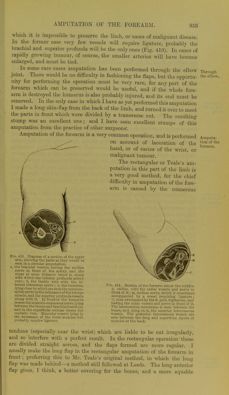 which it is impossible to preserve the limb, or cases of malignant disease. In the former case very few vessels will require ligature, probably the brachial and superior profunda will be the only ones (Fig, 413). In cases of rapidly growing tumour, of course, the smaller arteries will have become enlarged, and must be tied. In some rare cases amputation has been performed through the elbow xhi-ou-h joint. There would be no difficulty m fashioning the flaps, but the opportu- the elbow nity for performing the operation must be very rare, for any part of the forearm which can be preserved would be useful, and if the whole fore- arm is destroyed the humerus is also probably injured, and its end must be removed. In the only case in which I have as yet performed this amputation I made a long skin-flap from the back of the hmb, and turned it over to meet the parts m fi-ont which were divided by a transverse cut. The resulting stump was an excellent one; and I have seen excellent stumps of this amputation from the practice of other surgeons'. Amputation of the forearm is a very common operation, and is performed Amputa on account of laceration of the hand, or of caries of the wrist, or malignant tumour. The rectangular or Teale's am- putation in this part of the limb is a very good method, for the chief difficulty in amputation of the fore- arm is caused by the numerous tion of the forearm. Fig. 413. Diagram of a sectiou of the upper arm, showing the parts as they would be seen in a circular amputation, the brachial vessels, having the median nerve in front of the artery, and the ulnar at some distance below it, along with which the inferior profunda artery runs; B, the basilic vein with the in- ternal cutaneous nerve ; c, the humerus, lying close to which are seen the musculo- spiral nerve in the substance of the triceps muscle, and the superior profuuda vessels along with it. In front of the humerus is seen tliemusculo-cutaneous nerve lying between the bicejjs and brachialis anticus, and in the superficial cellular tissue the cephalic vein. JIuscular vessels lying in the substance of the three muscles will probably require ligature. Fig. 414. ^ Section of the forearm about the middle- it, radius, with the radial vessels and nerve in front of it; m, median nerve, which is sometimes accompanied by a vessel requiring ligature ; u, ulna overlapped by the fl. prof, digitorum, and having the ulnar vessels and nerve in front of it. The interosseous membrane is seen between the boues, and, lying on it, the anterior interosseous vessels. The posterior interosseous vessels are seen between the deep and superficiiil layers of muscles at the back. tendons (especially near the wrist) which are liable to be cut irregularly, and so interfere with a perfect result. In the rectangular operation these are divided straight across, and the flaps formed are more regular. I usually make the long flap in the rectangular amputation of the forearm in front; preferring this to Mr. Teale's original method, in which the long flap was made behind—a method still followed at Leeds. The long anterior flap gives, I think, a better covering for the bones, and a more equable