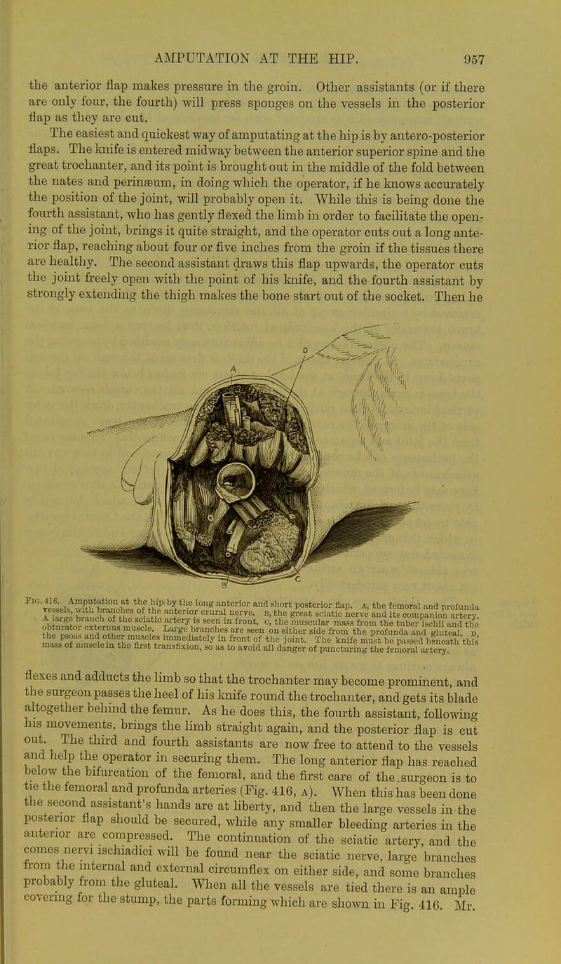the anterior flap makes pressure in the groin. Other assistants (or if there are only four, the fourth) wiU press sponges on the vessels in the posterior flap as they are cut. The easiest and quickest way of amputating at the hip is by antero-posterior flaps. The knife is entered midway between the anterior superior spine and the great trochanter, and its point is brought out in the middle of the fold between the nates and perinfeum, m doing which the operator, if he knows accurately the position of the joint, will probably open it. While this is being done the fourth assistant, who has gently flexed the hmb in order to facihtate the open- ing of the joint, brings it quite straight, and the operator cuts out a long ante- rior flap, reaching about four or five inches from the groin if the tissues there are healthy. The second assistant draws this flap upwards, the operator cuts the joint freely open with the point of his knife, and the fourth assistant by strongly extending the thigh makes the bone start out of the socket. Then he Fig. 416 Amputation at the hip by the long anterior and short posterior flap, a, the femoral and profunda r iL.: brithTtl,'p%°iK' ^' e'^''^ ^''^ ^''^^ con,pS artery A laige branch of the sciatic artery is seen m front, c, the muscular mass fi-om the tuber ischii and the obturator exteruus muscle. Large branches are seen on either side from the profunda an 1 gh tea i, mass'^o? mu°ci°i^ tLTf/f ™^'=^''t^-'y ^^ont of the joint. The knife must be passed bfnlth thft mass of muscle m the first transfixion, so as to avoid all danger of puncturing the femoral ai-tery. flexes and adducts the limb so that the trochanter may become prominent, and the surgeon passes the heel of his knife round the trochanter, and gets its blade altogether behmd the femur. As he does this, the fourth assistant, foUowing his movements, brings the limb straight agam, and the posterior flap is cut out. The third and fourth assistants are now free to attend to the vessels and help the operator in securing them. The long anterior flap has reached below the bifurcation of the femoral, and the first care of the surgeon is to tie the femoral and profunda arteries (Fig. 41G, a). When this has been done the second assistant's hands are at hberty, and then the large vessels in the posterior flap should be secured, while any smaller bleeding arteries in the anterior are compressed. The continuation of the sciatic artery, and the comes nervi ischiadici will be found near the sciatic nerve, large branches from the internal and external circumflex on either side, and some branches probably from the gluteal. When all the vessels are tied there is an ample covering for the stump, the parts forming which are shown in Fig. 416 Mr