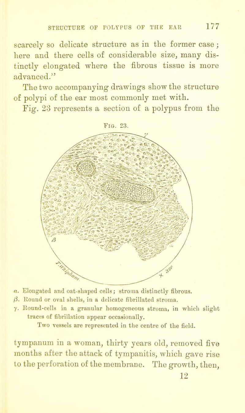 scarcely so delicate structure as in the former case; here and there cells of considerable size, many dis- tinctly elongated where the fibrous tissue is more advanced. The two accompanying drawings show the structure of polypi of the ear most commonly met with. Fig. 28 represents a section of a polypus from the 23. (5. Kound or oval shells, in a delicate fibrillated stroma. y. Kound-cells in a granular homogeneous stroma, in which slight traces of fibrillation appear occasionally. Two vessels are represented in the centre of the field. tympanum in a woman, thirty years old, removed five months after the attack of tympanitis, which gave rise to the perforation of the membrane. The growth, then, 12