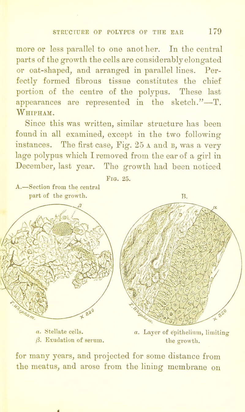 more or less pai'allel to one anot her. In the central parts of the growth the cells are considerably elongated or oat-shapedj and arranged in parallel lines. Per- fectly formed fibrous tissue constitutes the chief portion of the ceuti'e of the polypus. These last appearances are repi^esented in the sketch.—T, Whipham. Since this was written, similar structure has been found in all examined, except in the two following instances. The first case, Fig. 25 a and b, was a veiy lage polypus which I removed from the ear of a girl in December, last year. The growth had been noticed Fig. 25. A.—Section from tlie central part of the growth. B. a. Stellate cells. a. Laj'er of epithelium, limiting /?. Exudation of serum. the growth. for many years, and projected for some distance from the meatus, and arose from the lining membrane on