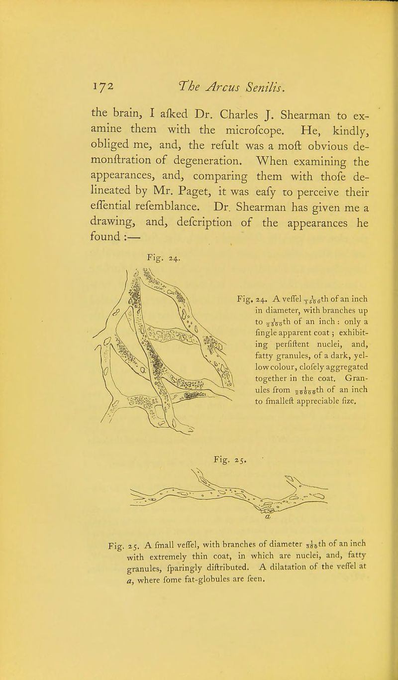 the brain, I afked Dr. Charles J. Shearman to ex- amine them with the microfcope. He, kindly, obliged me, and, the refult was a moft obvious de- monftration of degeneration. When examining the appearances, and, comparing them with thofe de- lineated by Mr. Paget, it was eafy to perceive their elTential refemblance. Dr. Shearman has given me a drawing, and, defcription of the appearances he found :— Fig. 24. Fig, 24. A veflel -j-Zsgth of an inch in diameter, with branches up to ^sVoth of an inch : only a fingle apparent coat; exhibit- ing perfiftent nuclei, and, fatty granules, of a dark, yel- low colour, clofely aggregated together in the coat. Gran- ules from assofftl^ of inch to fmalleft appreciable fize. Fig. 25. Fig. 25. A fmall veflel, with branches of diameter sJoth of an inch with extremely thin coat, in which are nuclei, and, fatty granules, fparingly diftributed. A dilatation of the veflel at a, where feme fat-globules are feen.