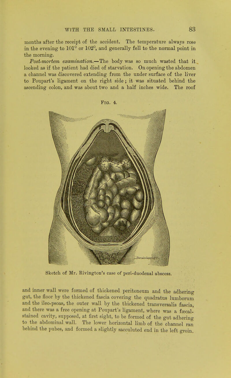 months after the receipt of the accident. The temperature always rose in the evening to 101° or 102°, and generally fell to the normal point in the morning. Post-mortem examination.—The body was so much wasted that it looked as if the patient had died of starvation. On opening the abdomen a channel was discovered extending from the under surface of the liver to Poupart's ligament on the right side; it was situated behind the ascending colon, and was about two and a half inches wide. The roof Fia. 4. Sketch of Mr, Rivington's case of peri-duodenal abscess. and inner wall were formed of thickened peritoneum and the adherino- gut, the floor by the thickened fascia covering the quadratus lumborum and the ileo-psoas, the outer wall by the thickened transversalis fascia, and there was a free opening at Poupart's ligament, where was a fjBcal- stained cavity, supposed, at first sight, to be formed of the gut adhering to the abdominal wall. The lower horizontal limb of the channel ran behind the pubes, and formed a slightly sacculuted end in the loft groin.