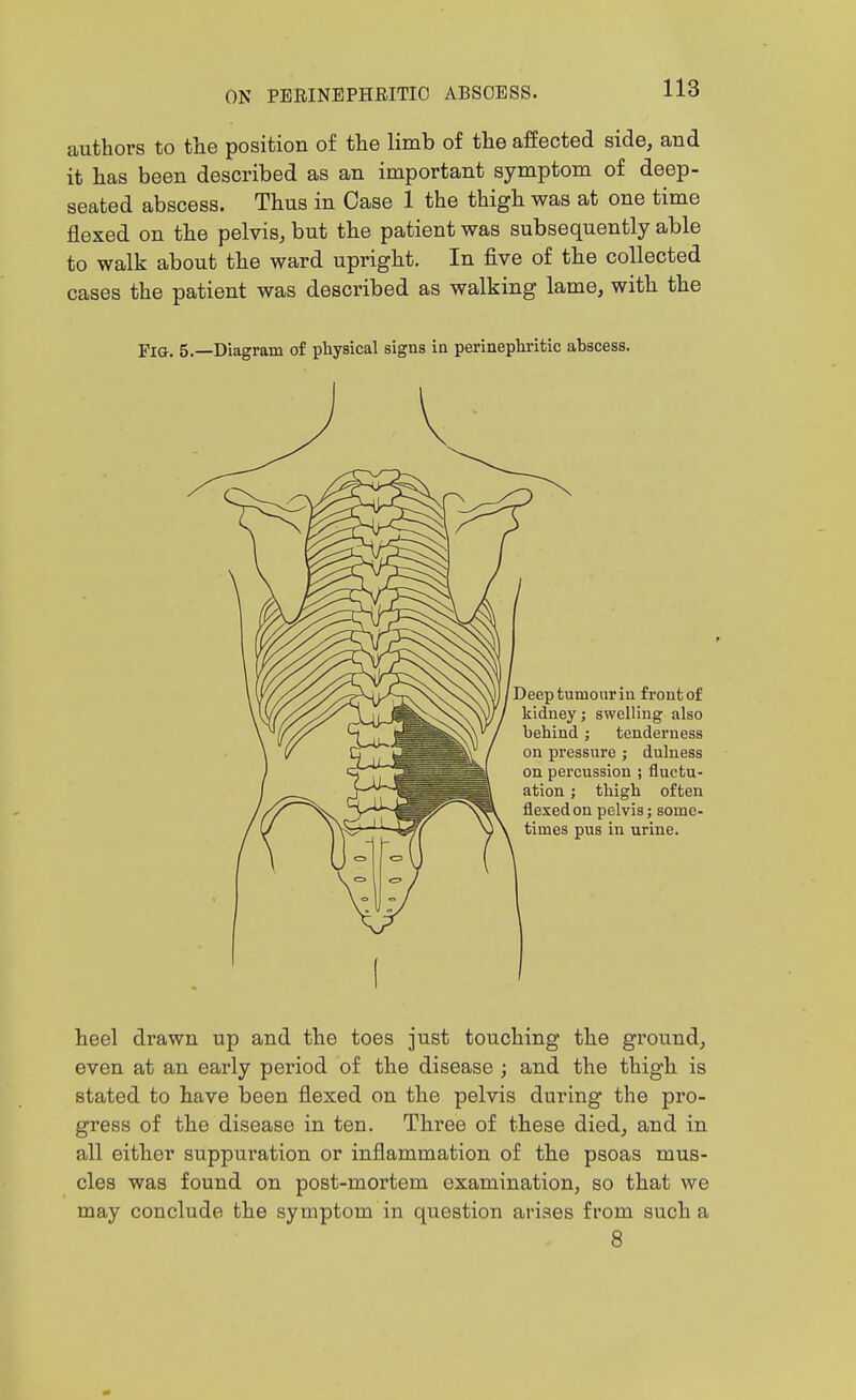 authors to tlie position of the limb of the affected side, and it has been described as an important symptom of deep- seated abscess. Thus in Case 1 the thigh was at one time flexed on the pelvis, but the patient was subsequently able to walk about the ward upright. In five of the collected cases the patient was described as walking lame, with the Fia. 5.—Diagram of physical signs in perinephritic abscess. Deep tumour in front of kidney; swelling also behind; tenderness on pressure ; duluess on percussion ; fluctu- ation ; thigh often flexed on pelvis; some- times pus in urine. heel drawn up and the toes just touching the ground, even at an early period of the disease ; and the thigh is stated to have been flexed on the pelvis during the pro- gress of the disease in ten. Three of these died, and in all either suppuration or inflammation of the psoas mus- cles was found on post-mortem examination, so that we may conclude the symptom in question arises from such a 8