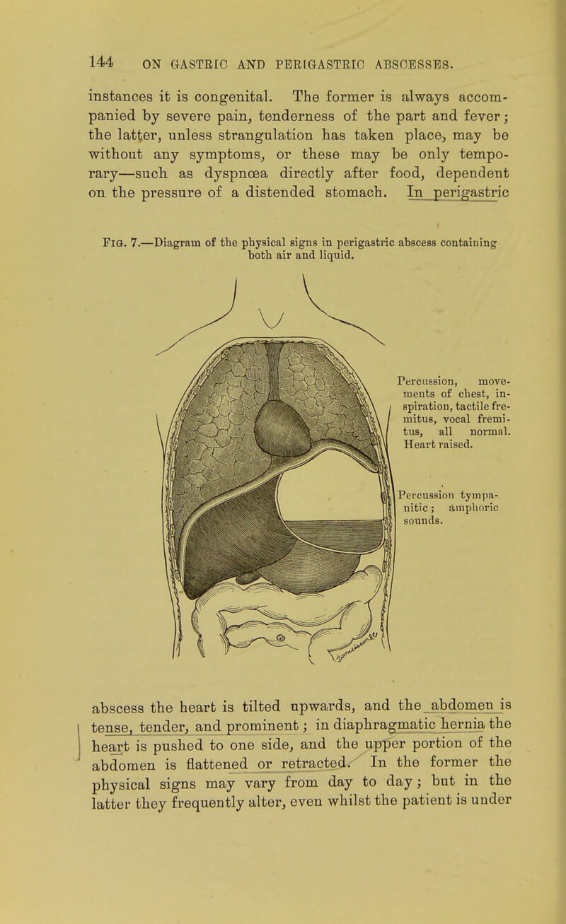 instances it is congenital. The former is always accom- panied by severe pain, tenderness of the part and fever; tlie latter, unless strangulation has taken place, may be without any symptoms, or these may be only tempo- rary—such as dyspnoea directly after food, dependent on the pressure of a distended stomach. In perigastric Fig. 7.—Diagram of the physical signs in perigastric abscess containing both air and liquid. Percussion, move- ments of chest, in- spiration, tactile fre- mitus, vocal fremi- tus, all normal. Heart raised. Percussion tympa- nitic ; amphoric sounds. abscess the heart is tilted upwards, and the abdomen is tense, tender, and prominent; in diaphragmatic hernia the heart is pushed to one side, and the upper portion of the abdomen is flattened or retracted. In the former the physical signs may vary from day to day; but in the latter they frequently alter, even whilst the patient is under