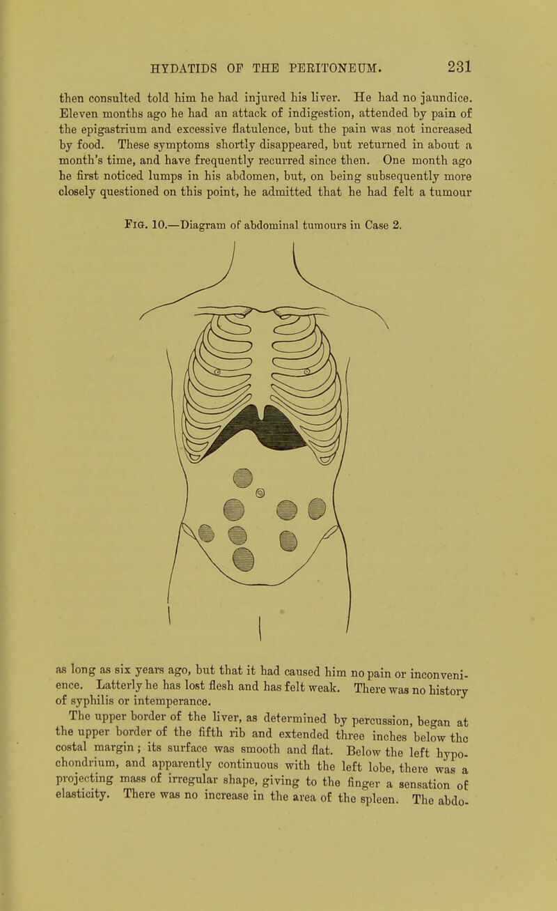 then consulted told him he had injured his liver. He had no jaundice. Eleven months ago he had an attack of indigestion, attended by pain of the epigastrium and excessive flatulence, but the pain was not increased by food. These symptoms shortly disappeared, but returned in about a month's time, and have frequently recurred since then. One month ago he first noticed lumps in his abdomen, but, on being subsequently more closely questioned on this point, he admitted that he had felt a tumour Fig. 10.—Diagram of abdominal tumours in Case 2. as long as six yeai-s ago, but that it had caused him no pain or inconveni- ence. Latterly he has lost flesh and has felt weak. There was no history of syphilis or intemperance. The upper border of the liver, as determined by percussion, began at the upper border of the fifth rib and extended three inches below the costal margin; its surface was smooth and flat. Below the left hypo- chondrium, and apparently continuous with the left lobe, there was a projecting mass of irregular shape, giving to the finger a sensation of elasticity. There was no increase in the area of the spleen. The abdo-