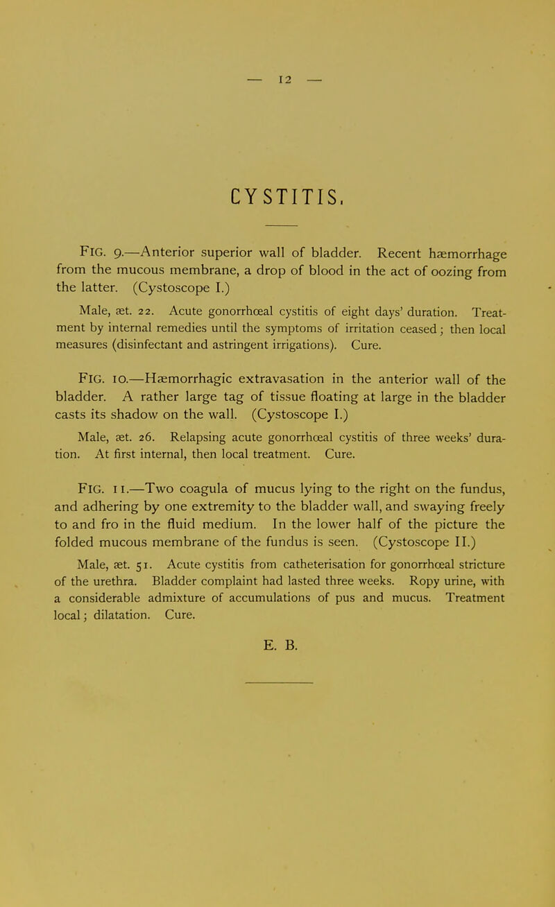 — 12 — CYSTITIS. Fig. 9.—Anterior superior wall of bladder. Recent haemorrhage from the mucous membrane, a drop of blood in the act of oozing from the latter. (Cystoscope I.) Male, aet. 22. Acute gonorrhoeal cystitis of eight days' duration. Treat- ment by internal remedies until the symptoms of irritation ceased; then local measures (disinfectant and astringent irrigations). Cure. Fig. 10.—Haemorrhagic extravasation in the anterior wall of the bladder. A rather large tag of tissue floating at large in the bladder casts its shadow on the wall. (Cystoscope I.) Male, aet. 26. Relapsing acute gonorrhoeal cystitis of three weeks' dura- tion. At first internal, then local treatment. Cure. Fig. II.—Two coagula of mucus lying to the right on the fundus, and adhering by one extremity to the bladder wall, and swaying freely to and fro in the fluid medium. In the lower half of the picture the folded mucous membrane of the fundus is seen. (Cystoscope II.) Male, aet. 51. Acute cystitis from catheterisation for gonorrhoeal stricture of the urethra. Bladder complaint had lasted three weeks. Ropy urine, with a considerable admixture of accumulations of pus and mucus. Treatment local; dilatation. Cure.