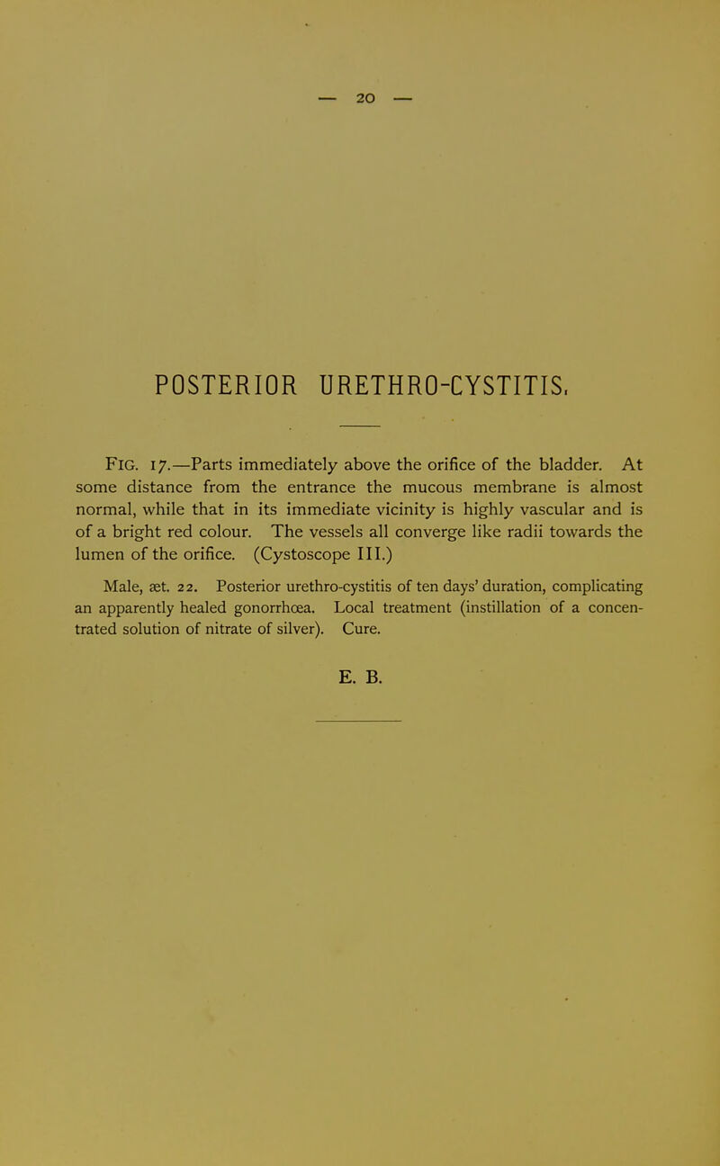 — 20 — POSTERIOR URETHRO-CYSTITIS. Fig. 17.—Parts immediately above the orifice of the bladder. At some distance from the entrance the mucous membrane is almost normal, while that in its immediate vicinity is highly vascular and is of a bright red colour. The vessels all converge like radii towards the lumen of the orifice. (Cystoscope III.) Male, set. 22. Posterior urethro-cystitis of ten days' duration, complicating an apparently healed gonorrhoea. Local treatment (instillation of a concen- trated solution of nitrate of silver). Cure.