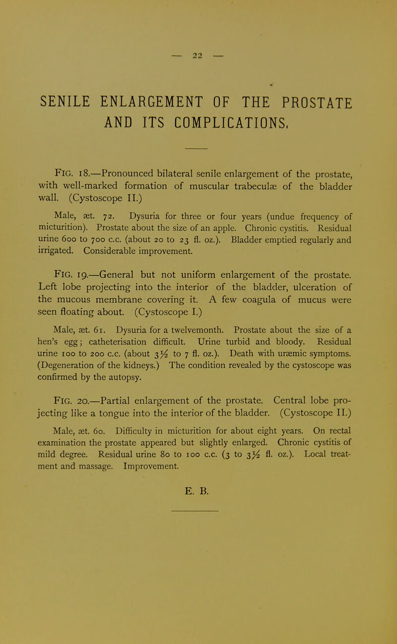 — 22 — SENILE ENLARGEMENT OF THE PROSTATE AND ITS COMPLICATIONS. Fig. 18.—Pronounced bilateral senile enlargement of the prostate, with well-marked formation of muscular trabeculae of the bladder wall. (Cystoscope II.) Male, aet. 72. Dysuria for three or four years (undue frequency of micturition). Prostate about the size of an apple. Chronic cystitis. Residual urine 600 to 700 c.c. (about 20 to 23 fl, oz.). Bladder emptied regularly and irrigated. Considerable improvement. Fig. 19.—General but not uniform enlargement of the prostate. Left lobe projecting into the interior of the bladder, ulceration of the mucous membrane covering it. A few coagula of mucus were seen floating about. (Cystoscope I.) Male, set. 61. Dysuria for a twelvemonth. Prostate about the size of a hen's egg; catheterisation difficult. Urine turbid and bloody. Residual urine 100 to 200 c.c. (about 3^ to 7 fl. oz.). Death with uraemic symptoms. (Degeneration of the kidneys.) The condition revealed by the cystoscope was confirmed by the autopsy. Fig. 20.—Partial enlargement of the prostate. Central lobe pro- jecting like a tongue into the interior of the bladder. (Cystoscope II.) Male, set. 60. Difficulty in micturition for about eight years. On rectal examination the prostate appeared but slightly enlarged. Chronic cystitis of mild degree. Residual urine 80 to 100 c.c. (3 to 3^ fl. oz.). Local treat- ment and massage. Improvement.