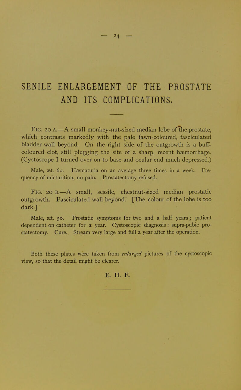 — 24 — SENILE ENLARGEMENT OF THE PROSTATE AND ITS COMPLICATIONS. Fig. 20 A.—A small monkey-nut-sized median lobe of the prostate, which contrasts markedly with the pale fawn-coloured, fasciculated bladder wall beyond. On the right side of the outgrowth is a buff- coloured clot, still plugging the site of a sharp, recent haemorrhage. (Cystoscope I turned over on to base and ocular end much depressed.) Male, set. 60. Hsematuria on an average three times in a week. Fre- quency of micturition, no pain. Prostatectomy refused. Fig. 20 B.—A small, sessile, chestnut-sized median prostatic outgrowth. Fasciculated wall beyond. [The colour of the lobe is too dark.] Male, set. 50. Prostatic symptoms for two and a half years; patient dependent on catheter for a year. Cystoscopic diagnosis : supra-pubic pro- statectomy. Cure. Stream very large and full a year after the operation. Both these plates were taken from enlarged pictures of the cystoscopic view, so that the detail might be clearer. E. H. F.