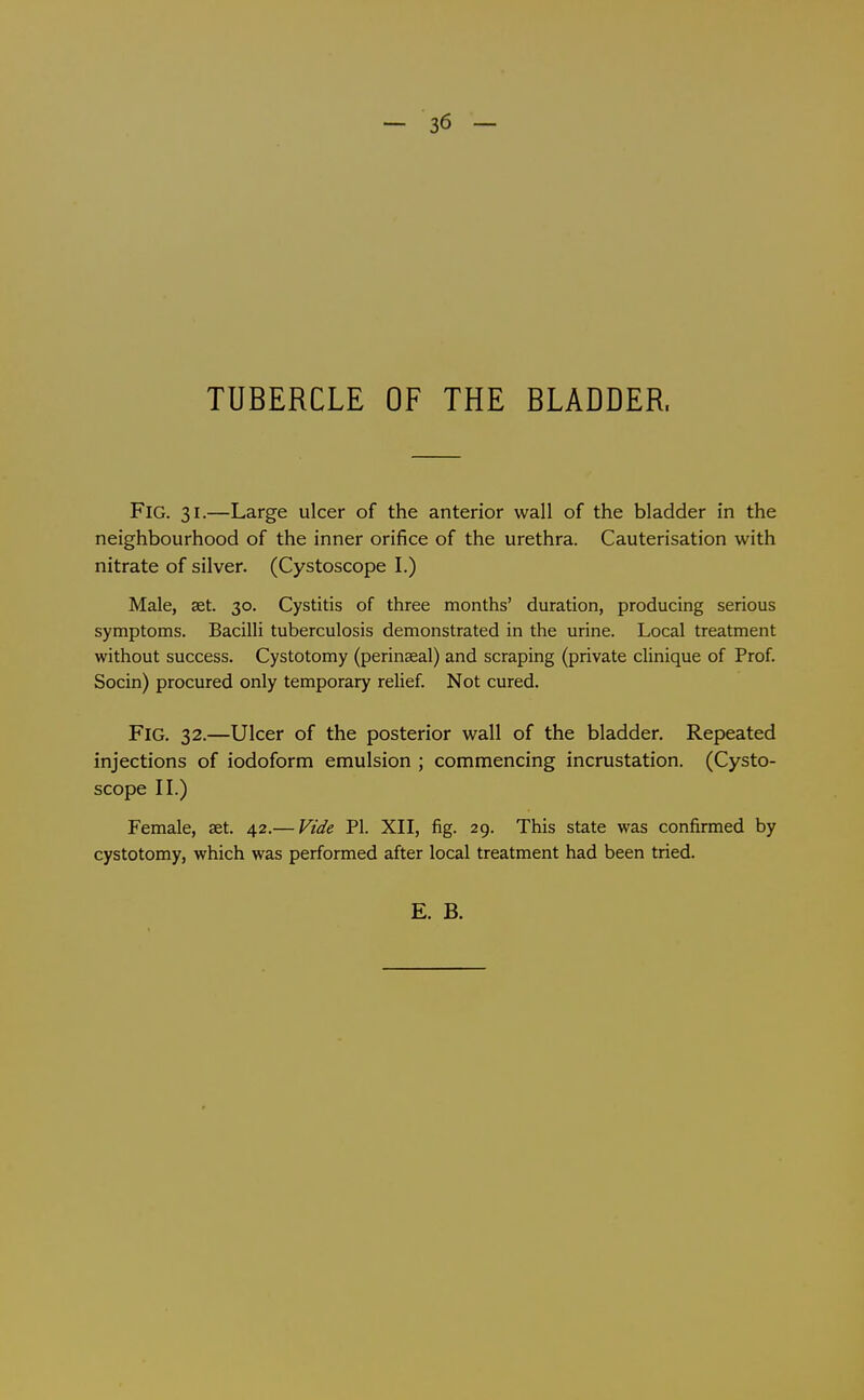 - 36 - TUBERCLE OF THE BLADDER. Fig. 31.—Large ulcer of the anterior wall of the bladder in the neighbourhood of the inner orifice of the urethra. Cauterisation with nitrate of silver. (Cystoscope I.) Male, set. 30. Cystitis of three months' duration, producing serious symptoms. Bacilli tuberculosis demonstrated in the urine. Local treatment without success. Cystotomy (perinseal) and scraping (private clinique of Prof. Socin) procured only temporary relief. Not cured. Fig. 32.—Ulcer of the posterior wall of the bladder. Repeated injections of iodoform emulsion ; commencing incrustation. (Cysto- scope II.) Female, set. 42.— Vide PI. XII, fig. 29. This state was confirmed by cystotomy, which was performed after local treatment had been tried.