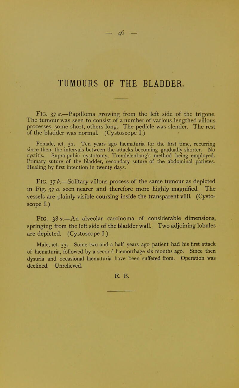 - 46 - TUMOURS OF THE BLADDER. Fig. 37 a;.—Papilloma growing from the left side of the trigone. The tumour was seen to consist of a number of various-lengthed villous processes, some short, others long. The pedicle was slender. The rest of the bladder was normal. (Cystoscope I.) Female, set. 52. Ten years ago haematuria for the first time, recurring since then, the intervals between the attacks becoming gradually shorter. No cystitis. Supra-pubic cystotomy, Trendelenburg's method being employed. Primary suture of the bladder, secondary suture of the abdominal parietes. Healing by first intention in twenty days. Fig. 37 b.—Solitary villous process of the same tumour as depicted in Fig. 37 a, seen nearer and therefore more highly magnified. The vessels are plainly visible coursing inside the transparent villi. (Cysto- scope I.) Fig. 38—An alveolar carcinoma of considerable dimensions, springing from the left side of the bladder wall. Two adjoining lobules are depicted. (Cystoscope I.) Male, set. 53. Some two and a half years ago patient had his first attack of haematuria, followed by a second haemorrhage six months ago. Since then dysuria and occasional haematuria have been suffered from. Operation was declined. Unrelieved.