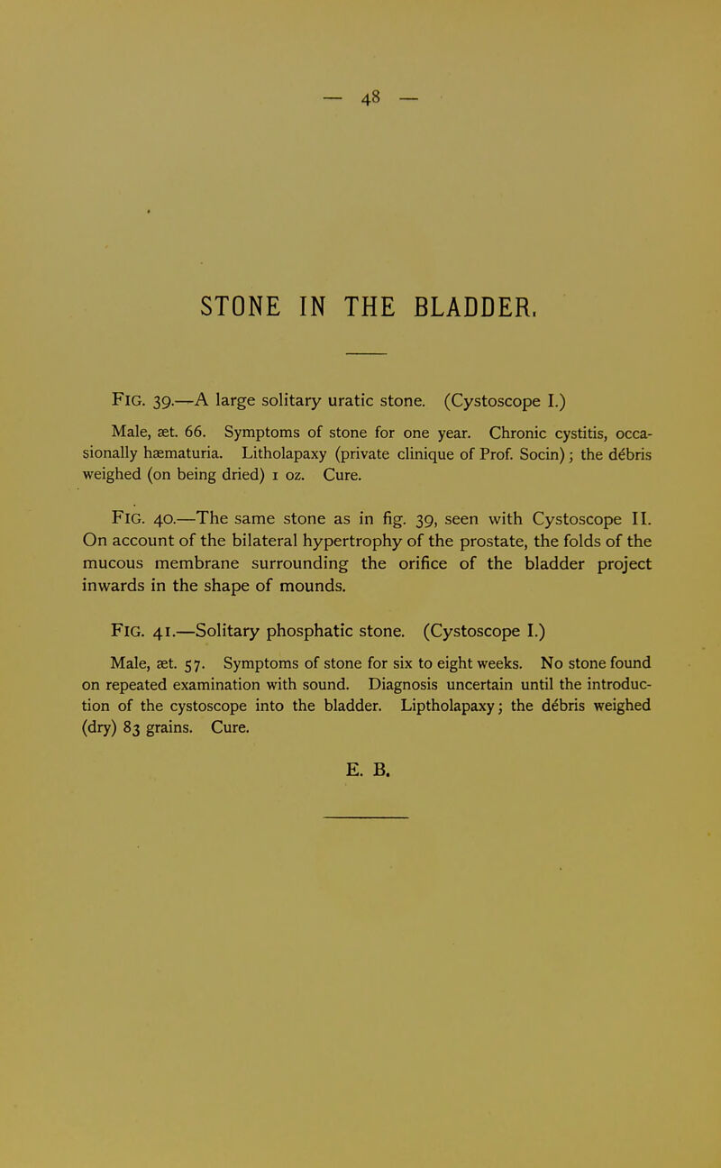 STONE IN THE BLADDER. Fig. 39.—a large solitary uratic stone. (Cystoscope I.) Male, set. 66. Symptoms of stone for one year. Chronic cystitis, occa- sionally haematuria. Litholapaxy (private clinique of Prof. Socin); the debris weighed (on being dried) i oz. Cure. Fig. 40.—The same stone as in fig. 39, seen with Cystoscope II. On account of the bilateral hypertrophy of the prostate, the folds of the mucous membrane surrounding the orifice of the bladder project inwards in the shape of mounds. Fig. 41.—Solitary phosphatic stone. (Cystoscope I.) Male, set. 57. Symptoms of stone for six to eight weeks. No stone found on repeated examination with sound. Diagnosis uncertain until the introduc- tion of the cystoscope into the bladder. Liptholapaxy; the debris weighed (dry) 83 grains. Cure.