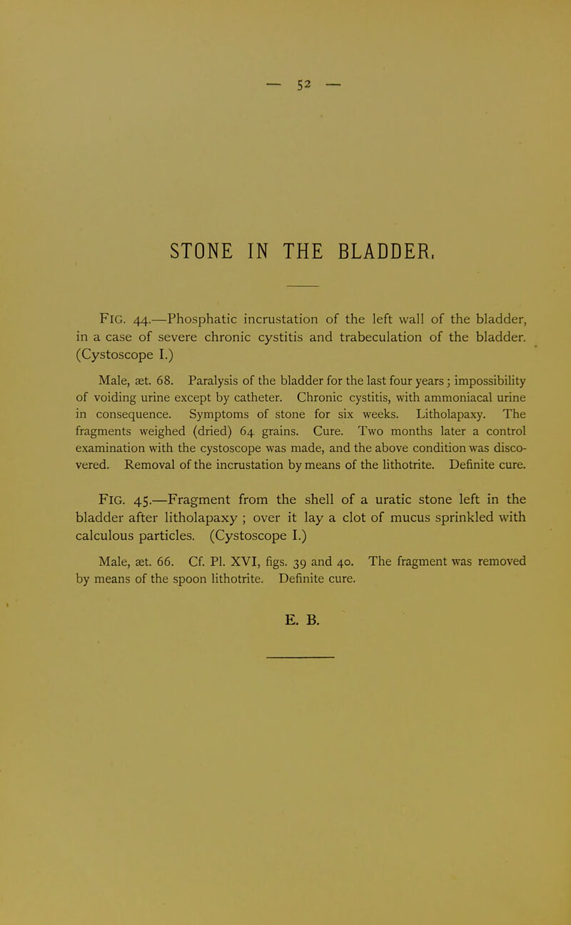 — 52 — STONE IN THE BLADDER. Fig. 44.—Phosphatic incrustation of the left wall of the bladder, in a case of severe chronic cystitis and trabeculation of the bladder. (Cystoscope I.) Male, set. 68. Paralysis of the bladder for the last four years; impossibility of voiding urine except by catheter. Chronic cystitis, with ammoniacal urine in consequence. Symptoms of stone for six weeks. Litholapaxy. The fragments weighed (dried) 64 grains. Cure. Two months later a control examination with the cystoscope was made, and the above condition was disco- vered. Removal of the incrustation by means of the lithotrite. Definite cure. Fig. 45.—Fragment from the shell of a uratic stone left in the bladder after litholapaxy ; over it lay a clot of mucus sprinkled with calculous particles. (Cystoscope I.) Male, aet. 66. Cf. PI. XVI, figs. 39 and 40. The fragment was removed by means of the spoon lithotrite. Definite cure.