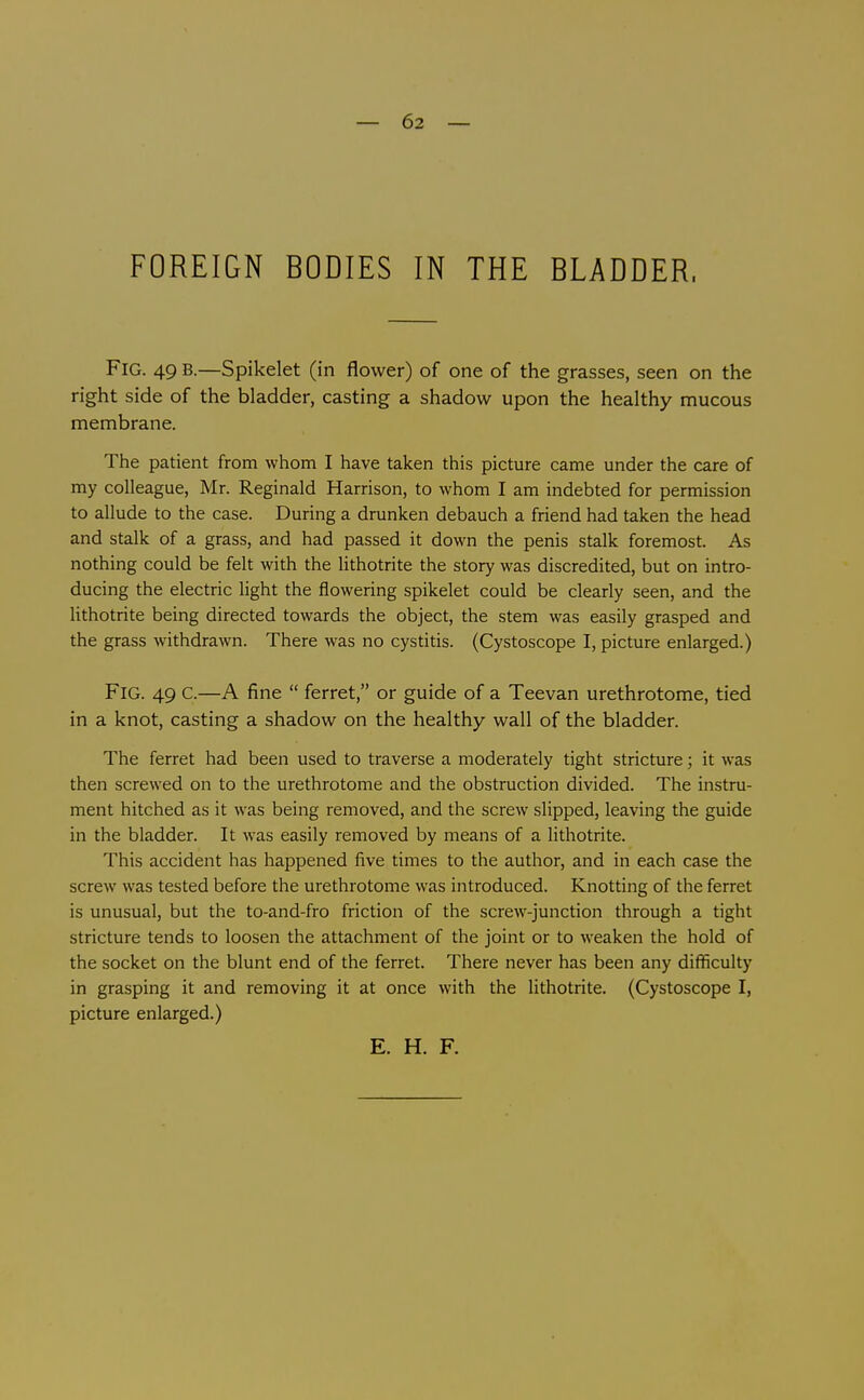 — 62 — FOREIGN BODIES IN THE BLADDER. Fig. 49 B.—Spikelet (in flower) of one of the grasses, seen on the right side of the bladder, casting a shadow upon the healthy mucous membrane. The patient from whom I have taken this picture came under the care of my colleague, Mr. Reginald Harrison, to whom I am indebted for permission to allude to the case. During a drunken debauch a friend had taken the head and stalk of a grass, and had passed it down the penis stalk foremost. As nothing could be felt with the lithotrite the story was discredited, but on intro- ducing the electric light the flowering spikelet could be clearly seen, and the Hthotrite being directed towards the object, the stem was easily grasped and the grass withdrawn. There was no cystitis. (Cystoscope I, picture enlarged.) Fig. 49 C.—A fine  ferret, or guide of a Teevan urethrotome, tied in a knot, casting a shadow on the healthy wall of the bladder. The ferret had been used to traverse a moderately tight stricture; it was then screwed on to the urethrotome and the obstruction divided. The instru- ment hitched as it was being removed, and the screw slipped, leaving the guide in the bladder. It was easily removed by means of a lithotrite. This accident has happened five times to the author, and in each case the screw was tested before the urethrotome was introduced. Knotting of the ferret is unusual, but the to-and-fro friction of the screw-junction through a tight stricture tends to loosen the attachment of the joint or to weaken the hold of the socket on the blunt end of the ferret. There never has been any difficulty in grasping it and removing it at once with the lithotrite. (Cystoscope I, picture enlarged.) E. H. F.