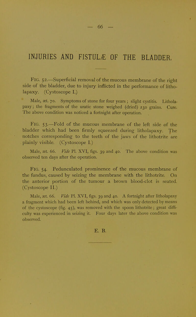 — 66 — INJURIES AND FISTQL^ OF THE BLADDER. Fig. 52.—Superficial removal of the mucous membrane of the right side of the bladder, due to injury inflicted in the performance of litho- lapaxy. (Cystoscope I.) Male, set. 70. Symptoms of stone for four years ; slight cystitis. Lithola- paxy; the fragments of the uratic stone weighed (dried) 230 grains. Cure. The above condition was noticed a fortnight after operation. Fig. 53.—Fold of the mucous membrane of the left side of the bladder which had been firmly squeezed during litholapaxy. The notches corresponding to the teeth of the jaws of the lithotrite are plainly visible. (Cystoscope I.) Male, eet. 66. Vide PI. XVI, figs. 39 and 40. The above condition was observed ten days after the operation. Fig. 54. Pedunculated prominence of the mucous membrane of the fundus, caused by seizing the membrane with the lithotrite. On the anterior portion of the tumour a brown blood-clot is .seated. (Cystoscope II.) Male, set. 66. Vide PI. XVI, figs. 39 and 40. A fortnight after litholapaxy a fragment which had been left behind, and which was only detected by means of the cystoscope (fig. 45), was removed with the spoon lithotrite; great difii- culty was experienced in seizing it. Four days later the above condition was observed.