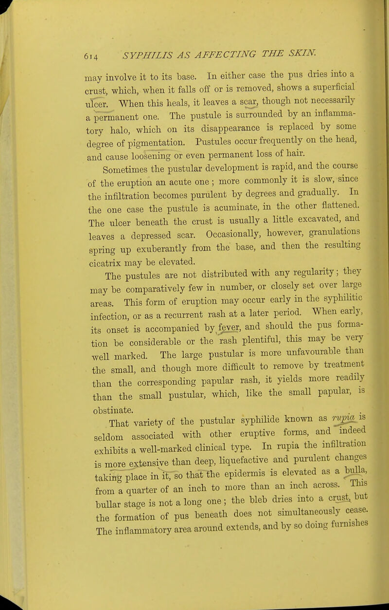 may involve it to its base. In either case the pus dries into a crust, which, when it falls off or is removed, shows a superficial ulcer. When this heals, it leaves a scar, though not necessarily a permanent one. The pustule is surrounded by an inflamma- tory halo, which on its disappearance is replaced by some degree of pigmentation. Pustules occur frequently on the head, and cause loosening or even permanent loss of hair. Sometimes the pustular development is rapid, and the course of the eruption an acute one; more commonly it is slow, since the infiltration becomes purulent by degrees and gradually. In the one case the pustule is acuminate, in the other flattened. The ulcer beneath the crust is usuaUy a little excavated, and leaves a depressed scar. Occasionally, however, granulations spring up exuberantly from the base, and then the resulting cicatrix may be elevated. The pustules are not distributed with any regularity; they may be comparatively few in number, or closely set over large areas. This form of eruption may occur early in the syphilitic infection, or as a recurrent rash at a later period. When early, its onset is accompanied by, fever, and should the pus forma- tion be considerable or the rash plentiful, this may be very well marked. The large pustular is more unfavourable than the small, and though more difficult to remove by treatment than the corresponding papular rash, it yields more readily than the small pustular, which, like the small papular-, is obstinate. . . That variety of the pustular syphilide known as n/gja is seldom associated with other eruptive forms, and indeed exhibits a well-marked clinical type. In rupia the infiltration is more extensive than deep, liquefactive and purulent changes taking place in it, so that the epidermis is elevated as a bulla, from a quarter of an inch to more than an inch across. This bullar stage is not a long one; the bleb dries into a crust, but the formation of pus beneath does not simultaneously cease. The inflammatory area around extends, and by so doing furnishes