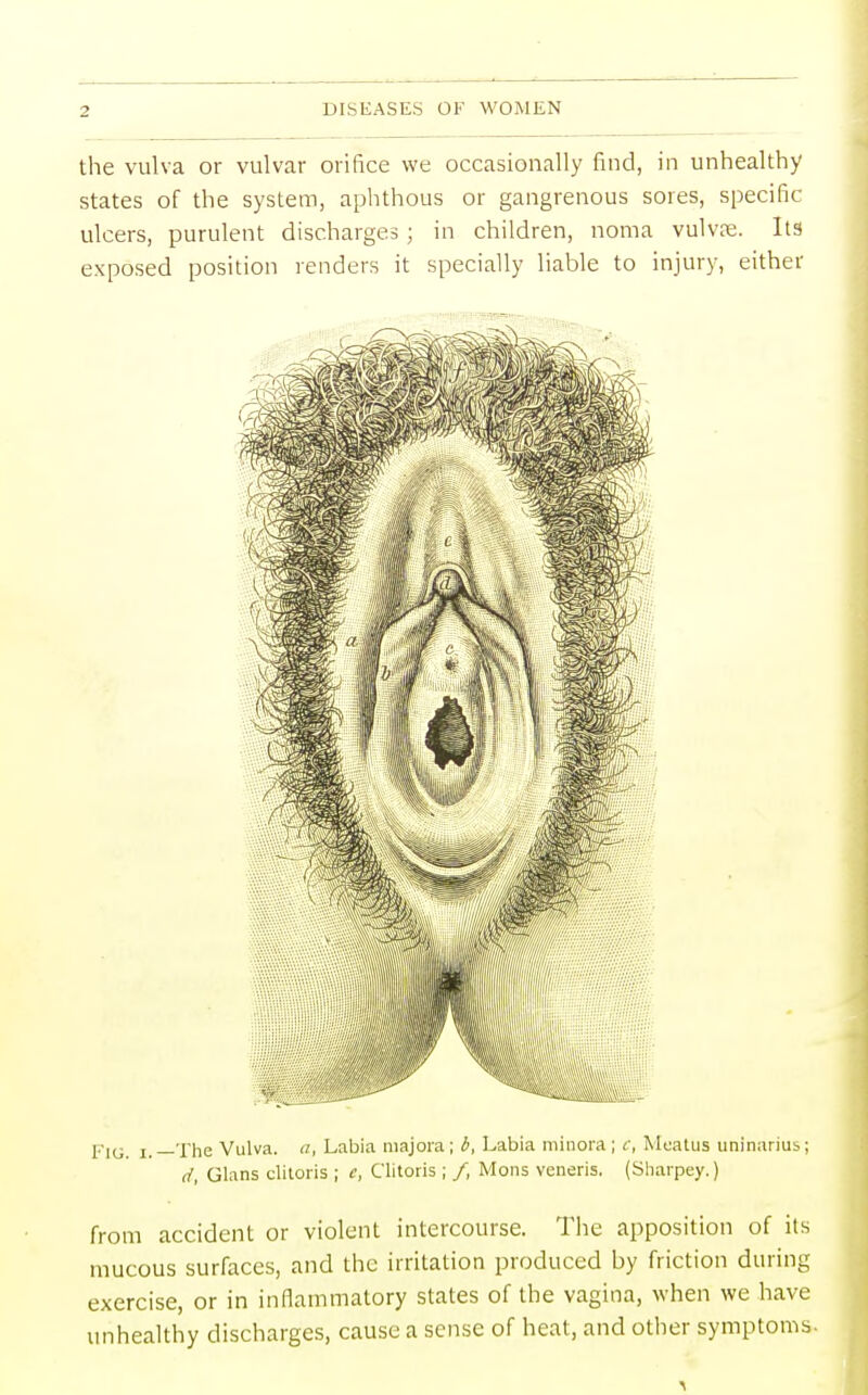 the vulva or vulvar orifice we occasionally find, in unhealthy states of the system, aphthous or gangrenous sores, specific ulcers, purulent discharges ; in children, noma vulvas. Its exposed position renders it specially liable to injury, either j.-,G j The Vulva, a, Labia niajora; b, Labia minora; c, Meatus uninarius; d, Glans clitoris ; e, Clitoris ; /, Mons veneris. (Sharpey.) from accident or violent intercourse. The apposition of its mucous surfaces, and the irritation produced by friction during exercise, or in inflammatory states of the vagina, when we have unhealthy discharges, cause a sense of heat, and other symptoms.