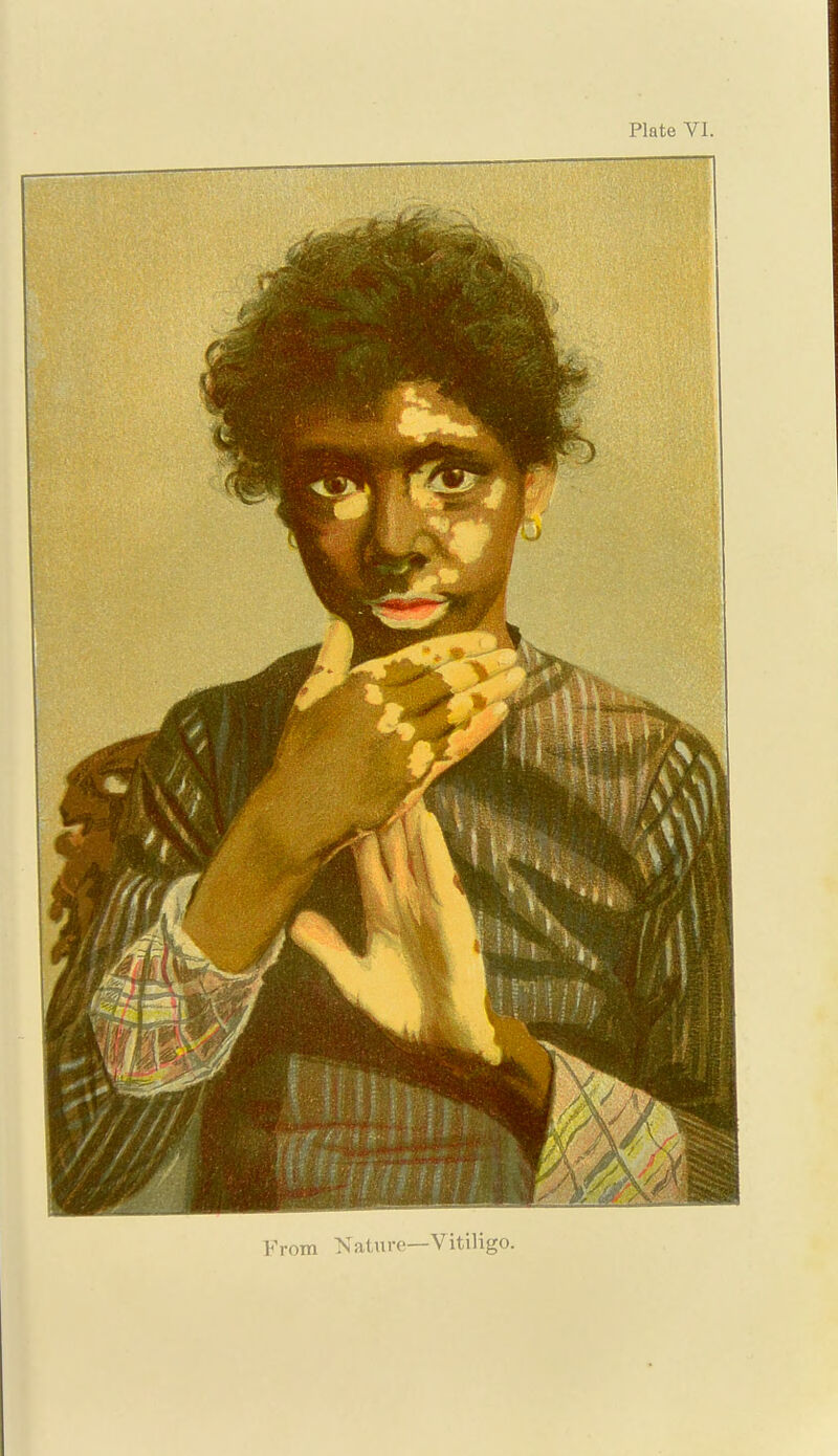 From Nature—Vitiligo.