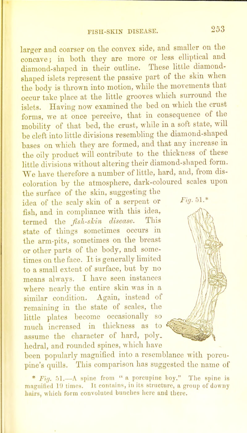 FISH-SKIN DISEASE. larger and coarser on tlie convex side, and smaller on the concave; in both they are more or less elliptical and diamond-shaped in their outline. These little diamond- shaped islets represent the passive part of the skin when the body is thrown into motion, while the movements that occur take place at the little grooves which surround the islets. Having now examined the bed on which the crust forms, we at once perceive, that in consequence of the mobility of that bed, the crust, while in a soft state, will be cleft into little divisions resembling the diamond-shaped bases on which they are formed, and that any increase in the oily product will contribute to the thickness of these little divisions without altering their diamond-shaped form. We have therefore a number of little, hard, and, from dis- coloration by the atmosphere, dark-coloured scales upon the surface of the skin, suggesting the idea of the scaly skin of a serpent or Fig- 51-* fish, and in compliance with this idea, termed the fish-sltin disease. This state of things sometimes occurs in the arm-pits, sometimes on the breast or other parts of the body, and some- times on the face. It is generally limited to a small extent of surface, but by no means always. I have seen instances where nearly the entire skin was in a similar condition. Again, instead of remaining in the state of scales, the little plates become occasionally so much increased in thickness as to assume the character of hard, poly, hedral, and rounded spines, which have been popularly magnified into a resemblance with porcu- pine's quills. This comparisoR has suggested the name of * //>/. 51.—A spiiio from  n porcupine boy. Tlic K]iiiie is irmgiiilied 1!) tirni's. It ('oiitaiiis, in iis striiotiiro, a gruiip of downy hairs, wliicli form convoluted biuicbcs berc and tbero.