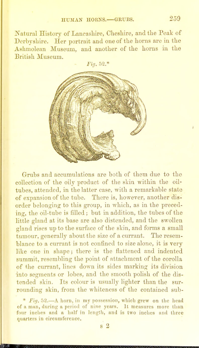 jSTatural History of Lancashire, Cliesliire, and tlie Peak of Derbyshire. Her portrait and one of the horns are in the Ashmolean Museum, and another of the horns in the Britisli Museum. Grubs and accumulations are both of them due to the collection of the oily product of the skia within the oil- tubes, attended, in the latter case, with a remarkable state of expansion of the tube. There is, however, another dis- order belonging to this group, in which, as in the preced- ing, the oil-tube is filled ; but in addition, the tubes of the little gland at its base are also distended, and the swollen gland rises up to the surface of the skin, and forms a small tumour, generally about the size of a currant. The resem- blance to a currant is not confined to size alone, it is very like one in shape; there is the flattened and indented summit, resembling the point of attachment of the corolla of the currant, linos down its sides marking its division into segments or lobes, and the smooth polish of the dis- tended skin. Its colour is nsiially lighter than the sur- rounding skin, from the whiteness of the contained sub- * Fi;/. 52.—A liorn, in my possession, wbicli grew on tlio liead of a man, (luring a pei iotl of nine years. It measures more llian fonr inches anil n half in length, and is two inches inul tliree quarters in circumfereuce. s 2