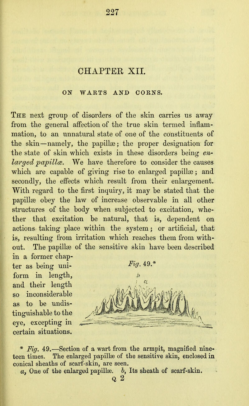 CHAPTER XII. ON WAETS AND CORNS. The next group of disorders of the skin carries us away from the general affection of the true skin termed inflam- mation, to an unnatural state of one of the constituents of the skin—namely, the papillae; the proper designation for the state of skin which exists in these disorders being en- larged 'pajpillce. We have therefore to consider the causes which are capable of giving rise to enlarged papillae; and secondly, the effects which result from their enlargement. With regard to the first inquiry, it may be stated that the papillae obey the law of increase observable in all other structures of the body when subjected to excitation, whe- ther that excitation be natural, that is, dependent on actions taking place within the system; or artificial, that is, resulting from irritation which reaches them from with- out. The papillae of the sensitive skin have been described in a former chap- ter as being uni- form in length, and their length so inconsiderable as to be undis- tinguishable to the eye, excepting in certain situations. Fig. 49.^ * Fig. 49.—Section of a wart from the armpit, magnified nine- teen times. The enlarged papillae of the sensitive skin, enclosed in conical sheaths of scarf-skin, are seen. a, One of the enlarged papillae, &, Its sheath of scarf-skin, Q 2