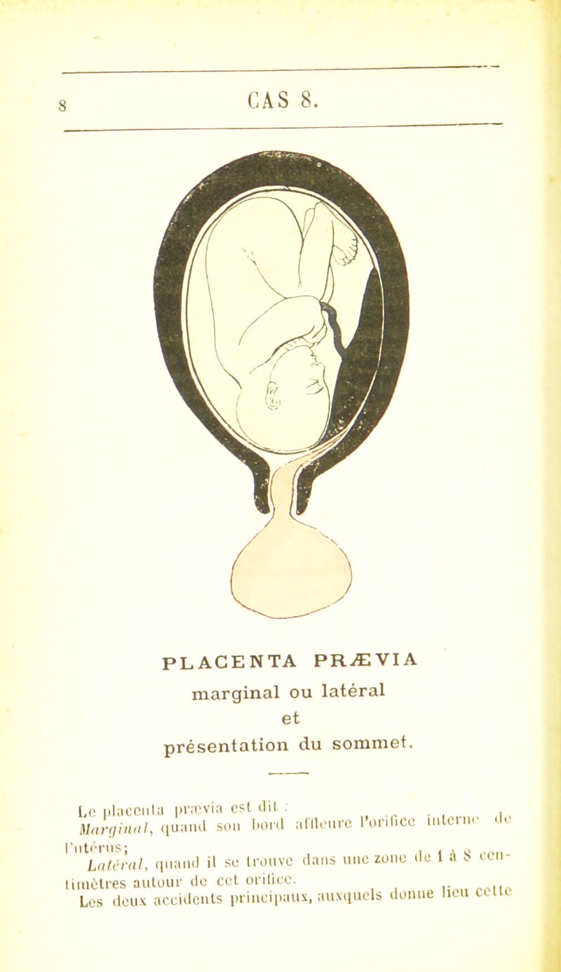 8 PLACENTA PRiEVIA marginal ou latéral et présentation du sommet. I,o placenta nrœvia esL d'il . . , . Marginal, quand son bord arfleure l'orifice interne d latéral, quand il se Irouve dans une zone de 1 à 8 cen limôtres autour de cet orilicc.