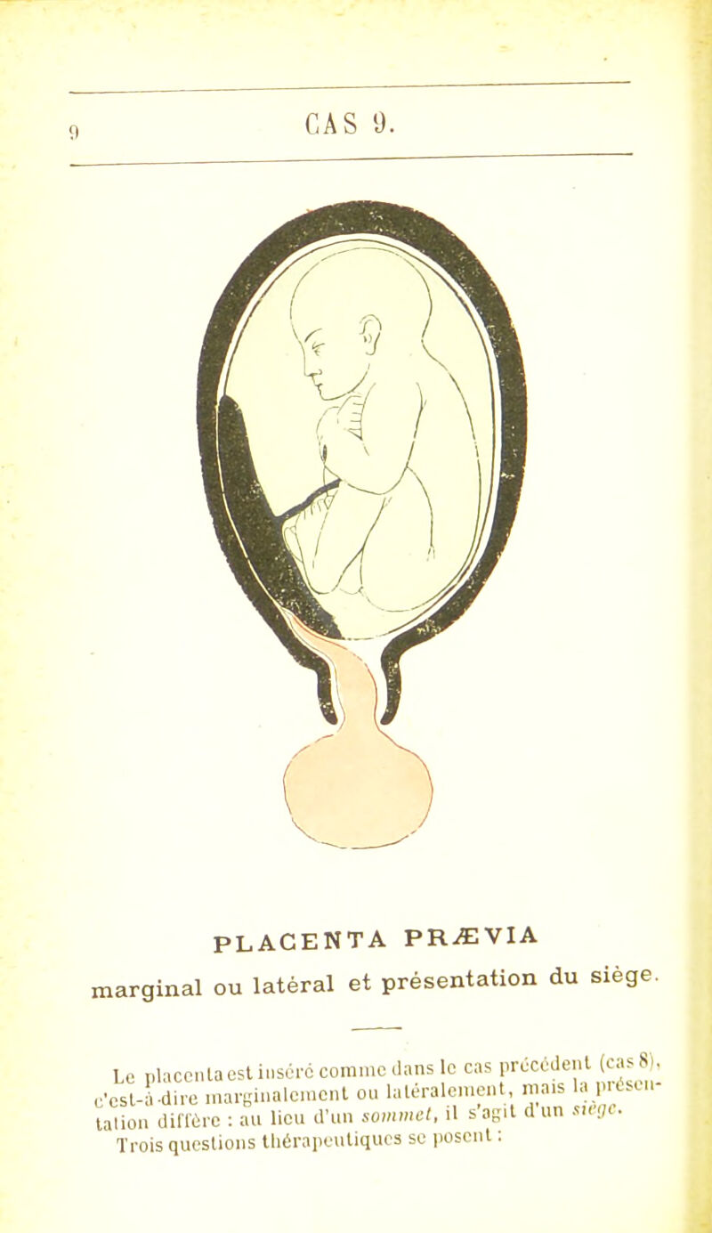 PLACENTA PR^EVIA marginal ou latéral et présentation du siège. Le placenta est inséré com.no dans le cas précèdent (cas 8 , c'est-à-dire marginalement on latéralement, mais la presen- talion diffère : an lien d'un sommet, il s'agit d nn siège. Trois questions thérapeutiques se posent :